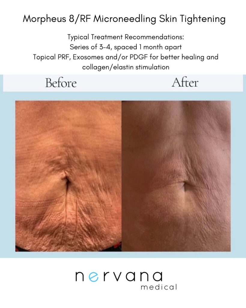 Morpheus - RF Microneedling in Sandy, UT