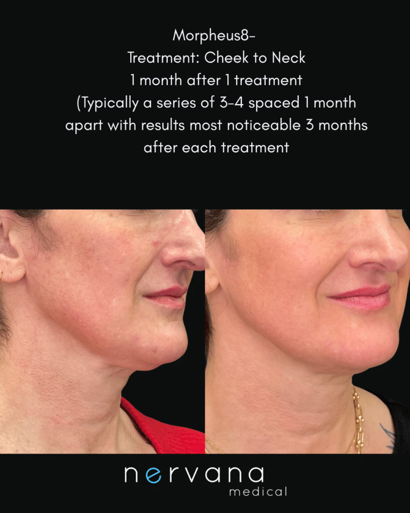 Before and After Image: Morpheus 8- 1 month after first treatment - right-side