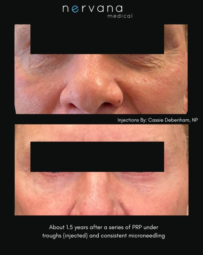 PRP Injections in Sandy, UT