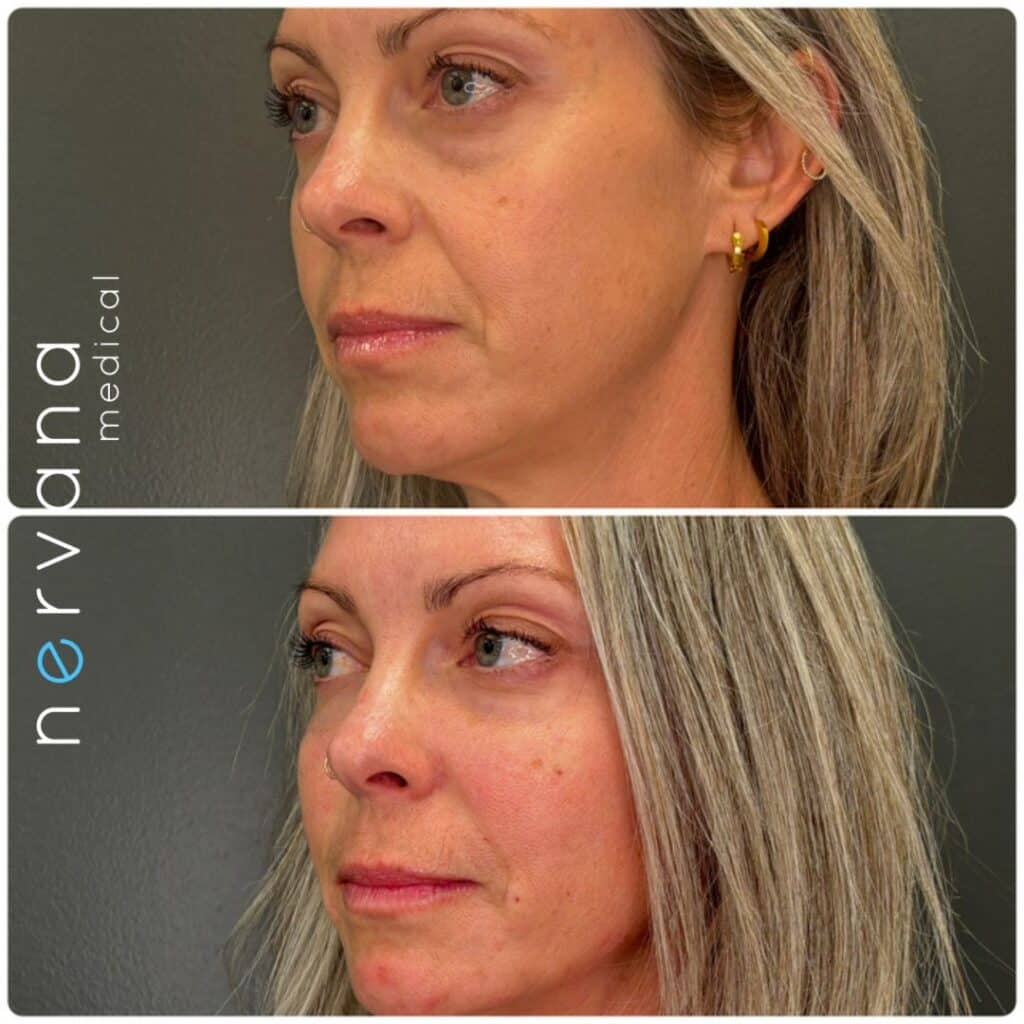 Before and After Image: Troughs - left-front-oblique