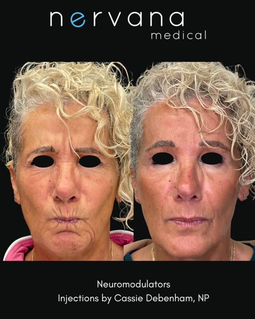 Botox/Dysport in Sandy, UT