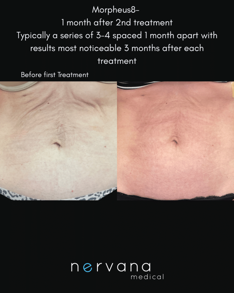 Before and After Image: Morpheus 8 Abdomen - right-front-oblique