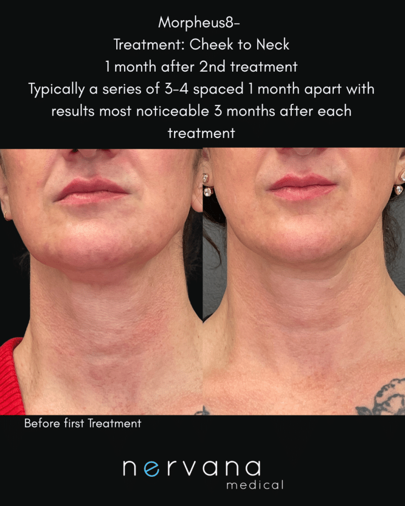 Before and After Image: Morpheus 8 (Just before third treatment; 2 months since 1st treatment) - right-side