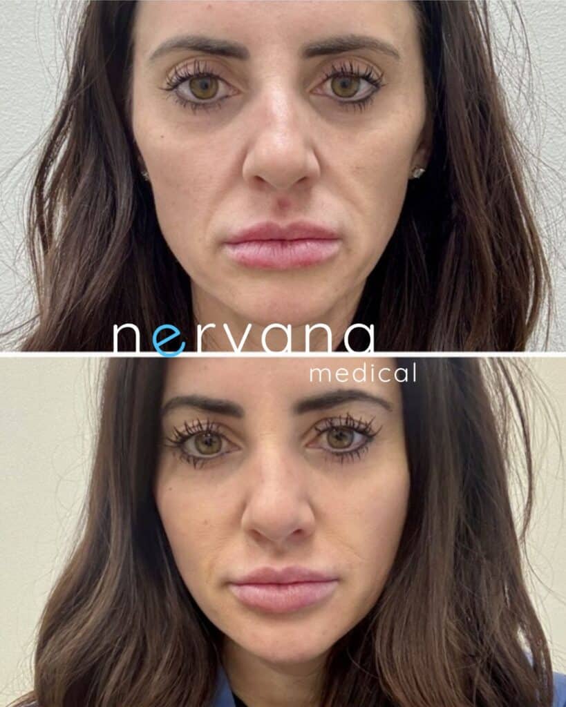Biostimulators (Radiesse, Sculptra) in Sandy, UT