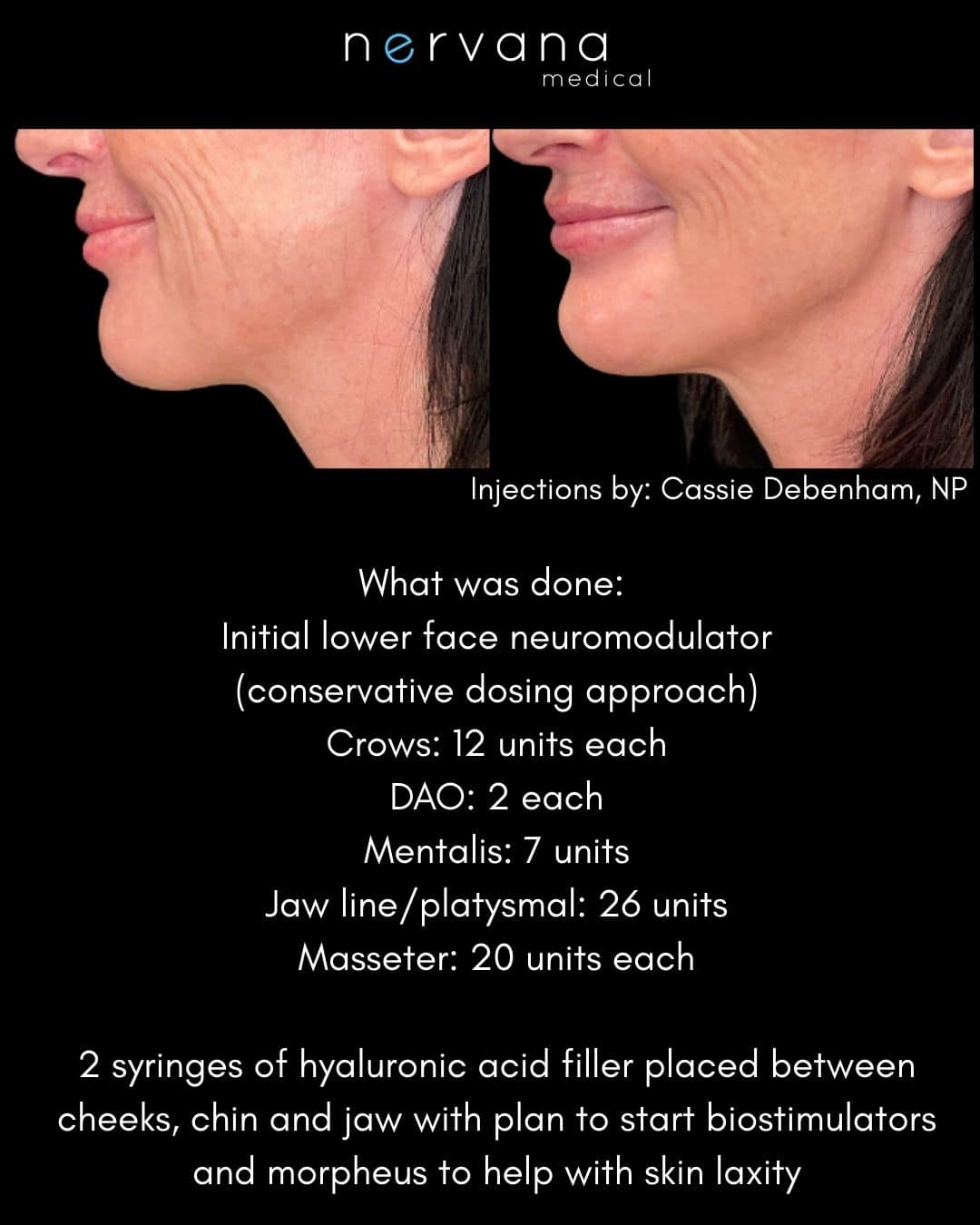 Before and After Image: Initial Lower Face Neuromodulator - left-side
