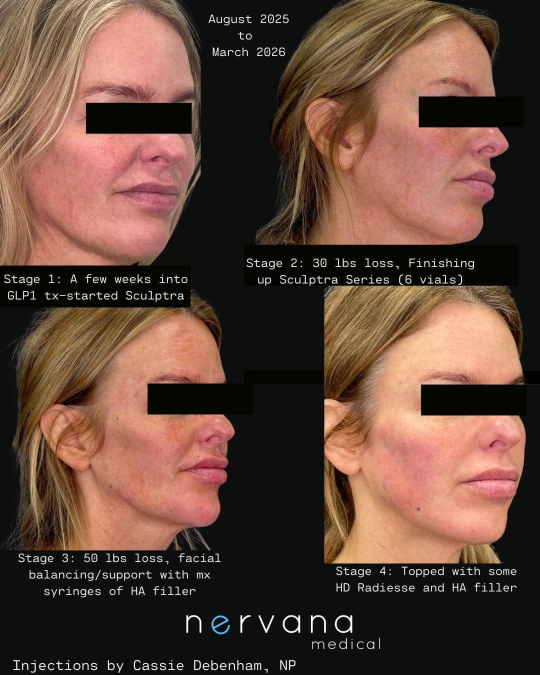 Before and After Image: Injections - right-front-oblique