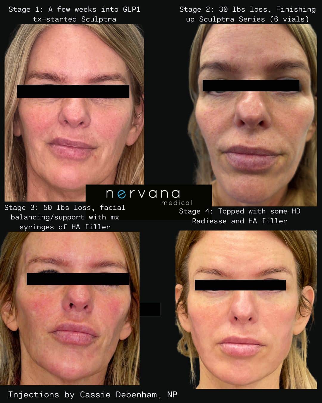 Before and After Image: Injections - front