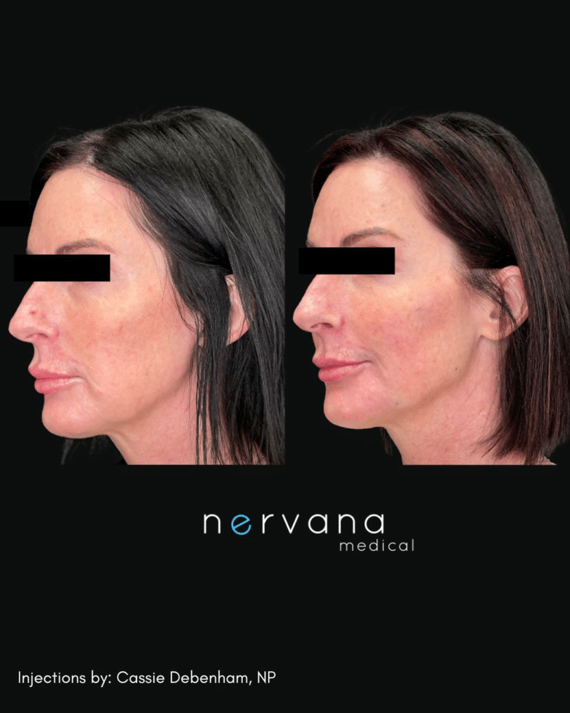 Before and After Image: Injections - left-front-oblique