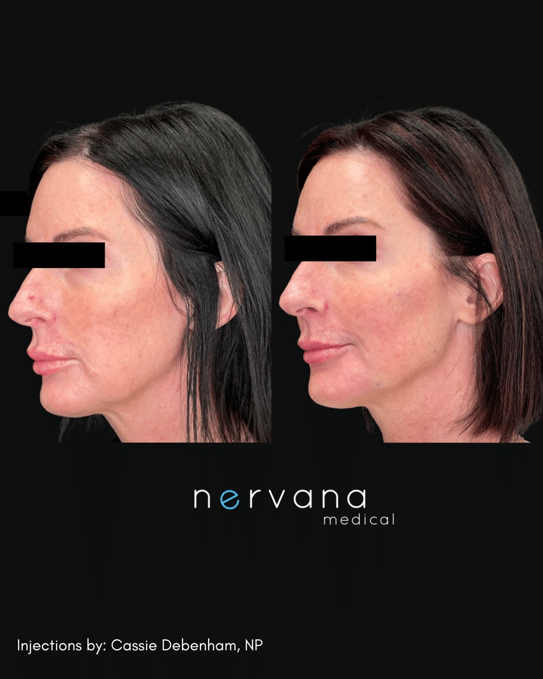 Before and After Image: Injections - left-front-oblique