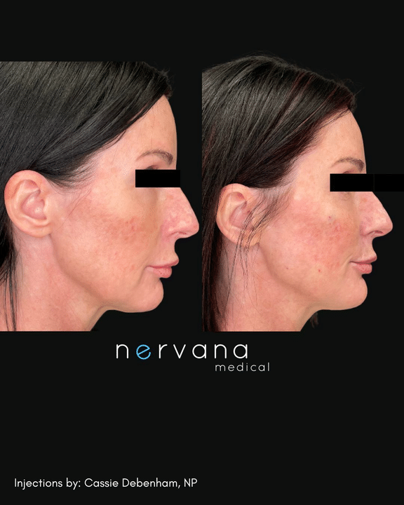 Before and After Image: Injections - right-side