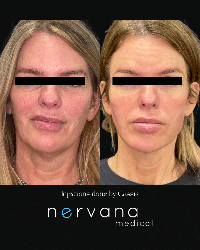 Before and After Image: Injections - front