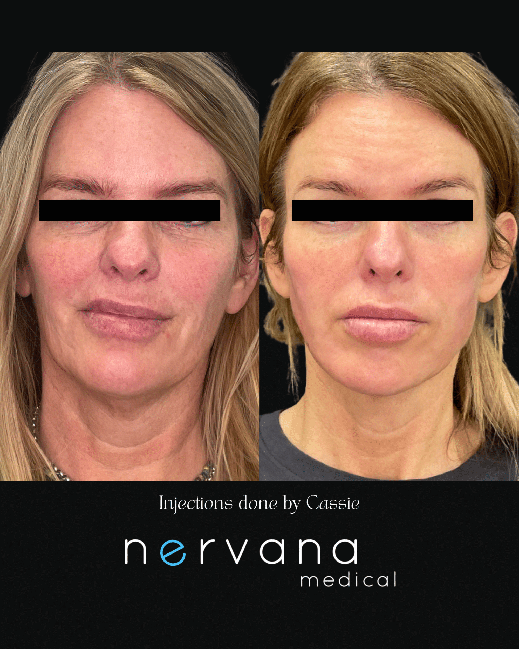 Before and After Image: Injections - front