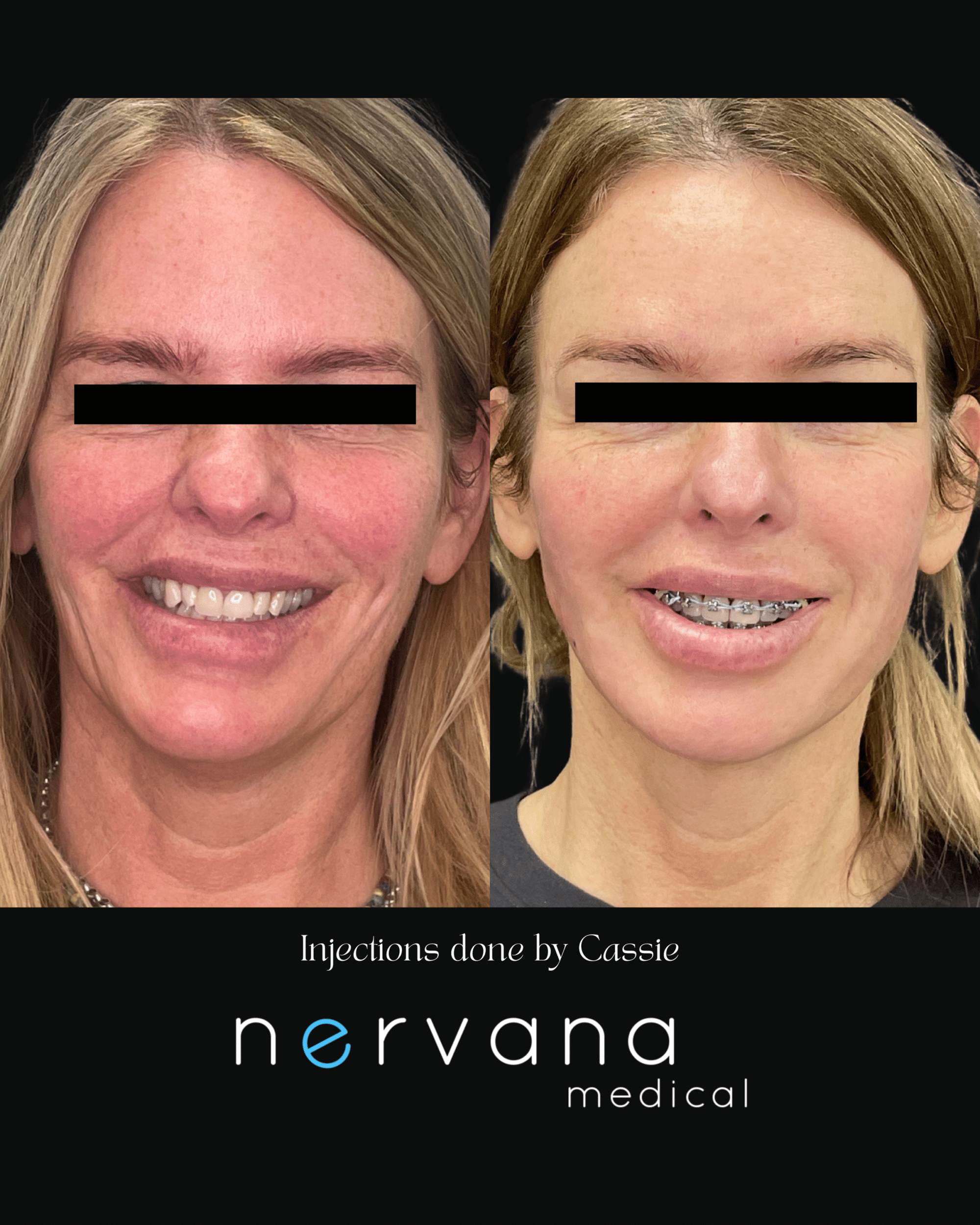 Before and After Image: Injections - front