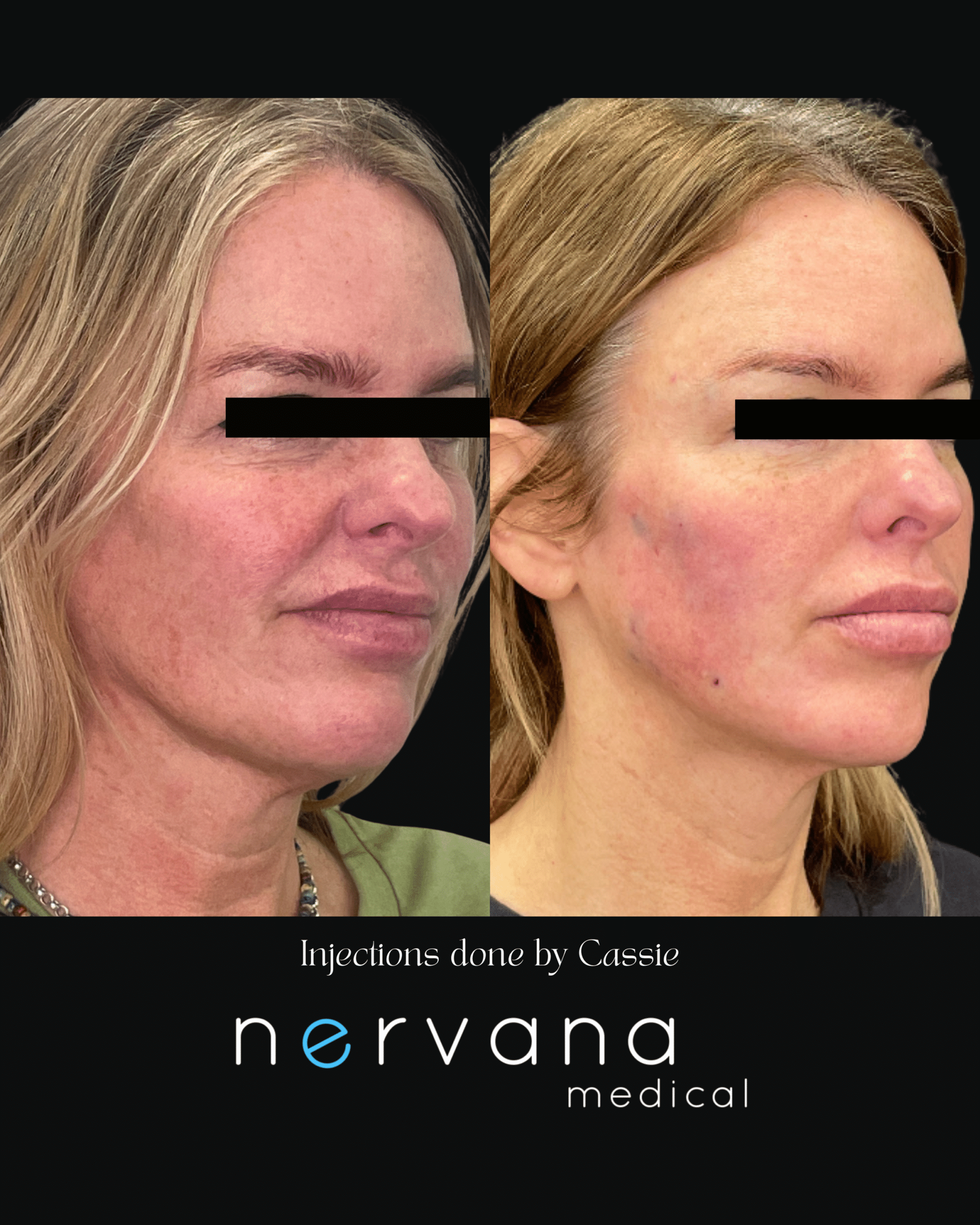 Before and After Image: Injections - right-front-oblique