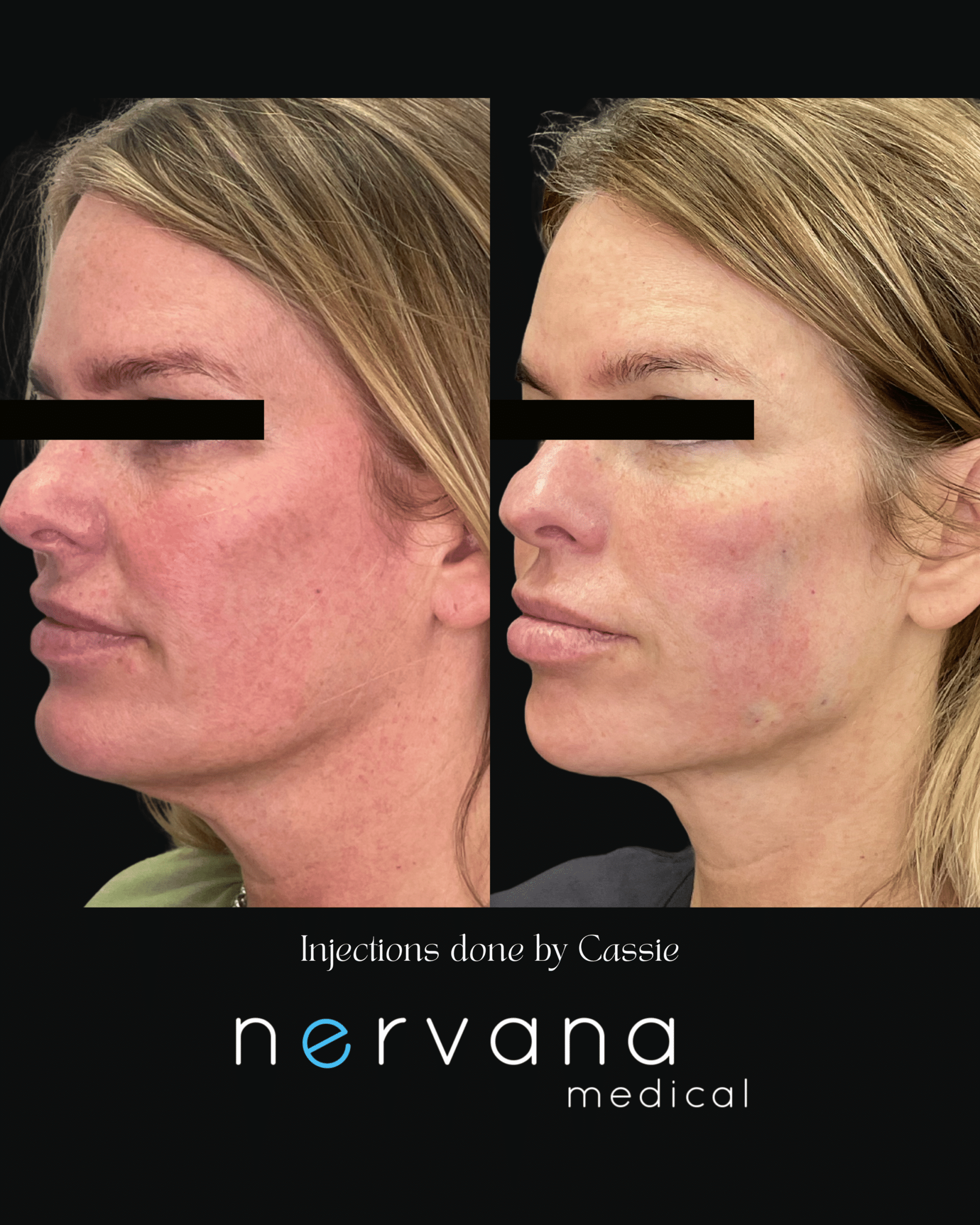 Before and After Image: Injections - left-front-oblique