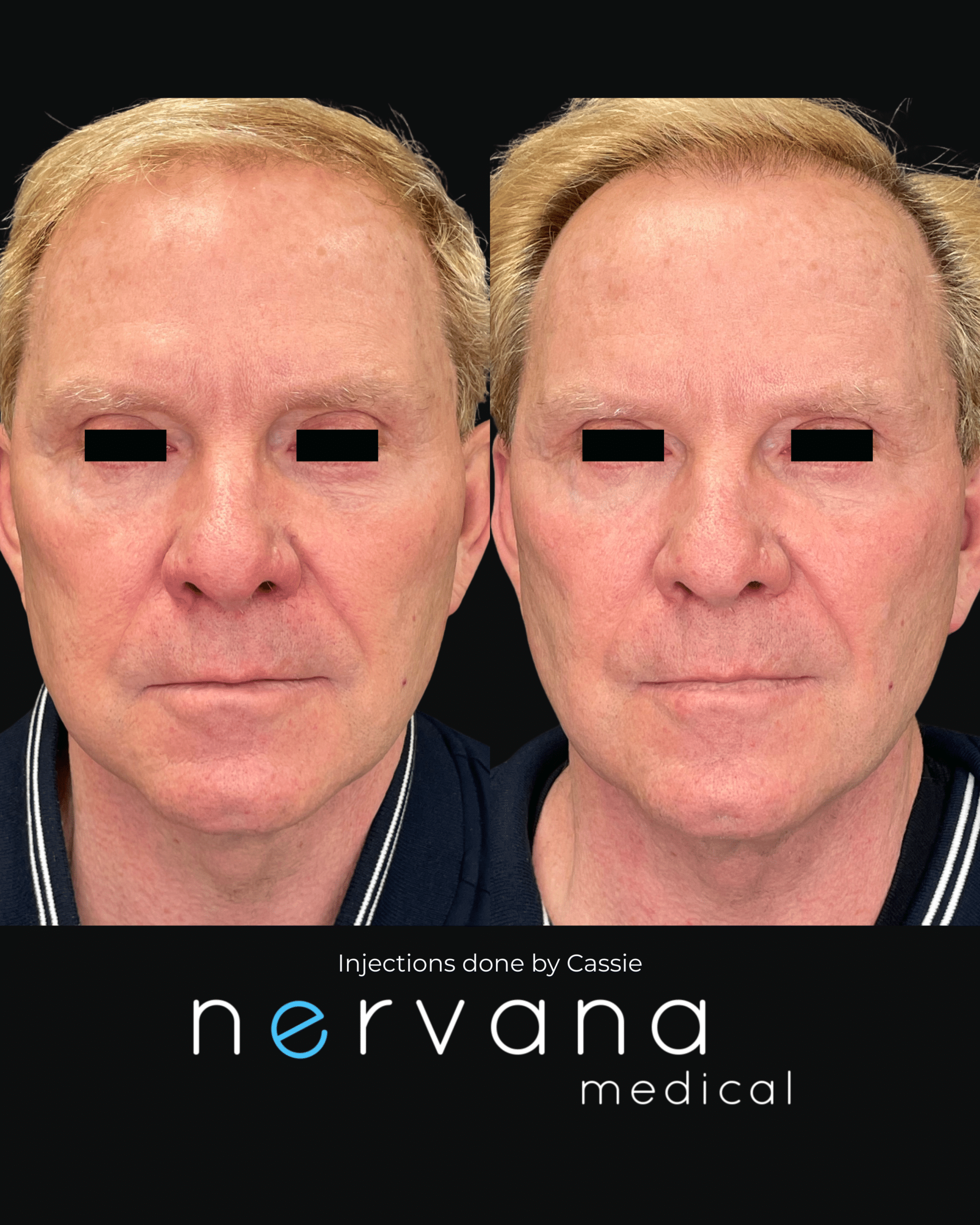 Before and After Image: Injections - front