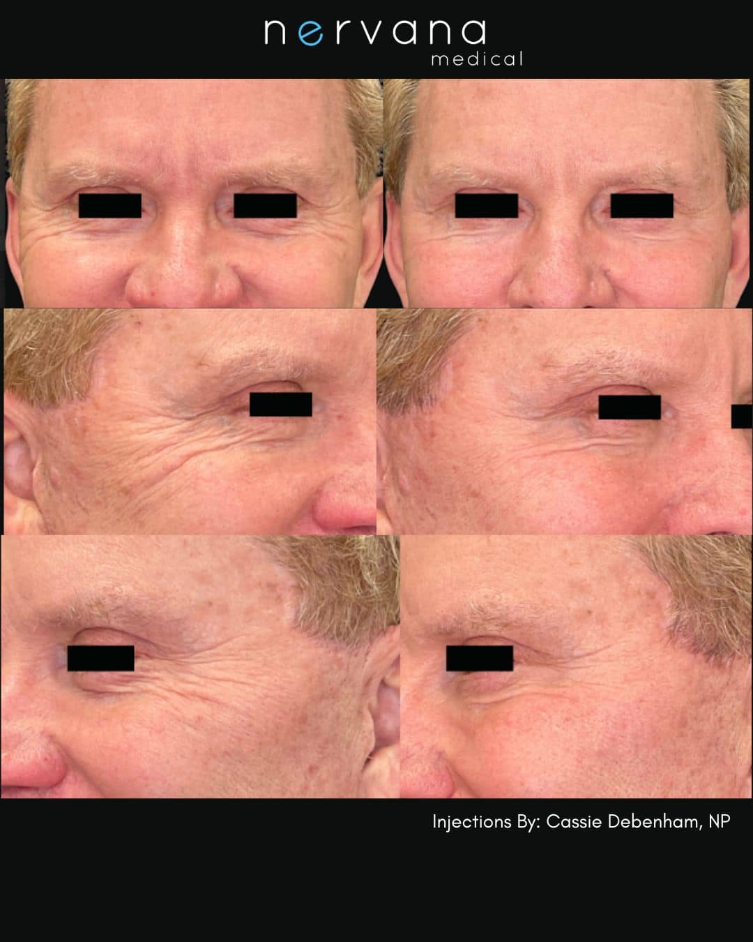 Before and After Image: Injections - front