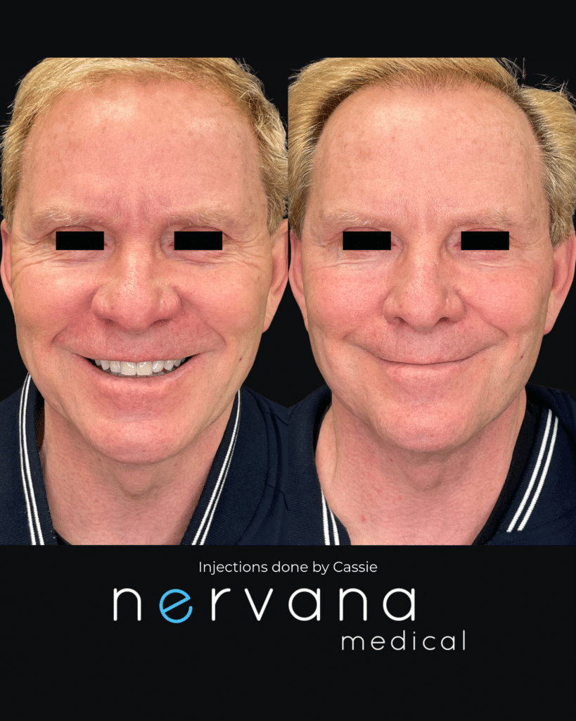 Before and After Image: Injections - front