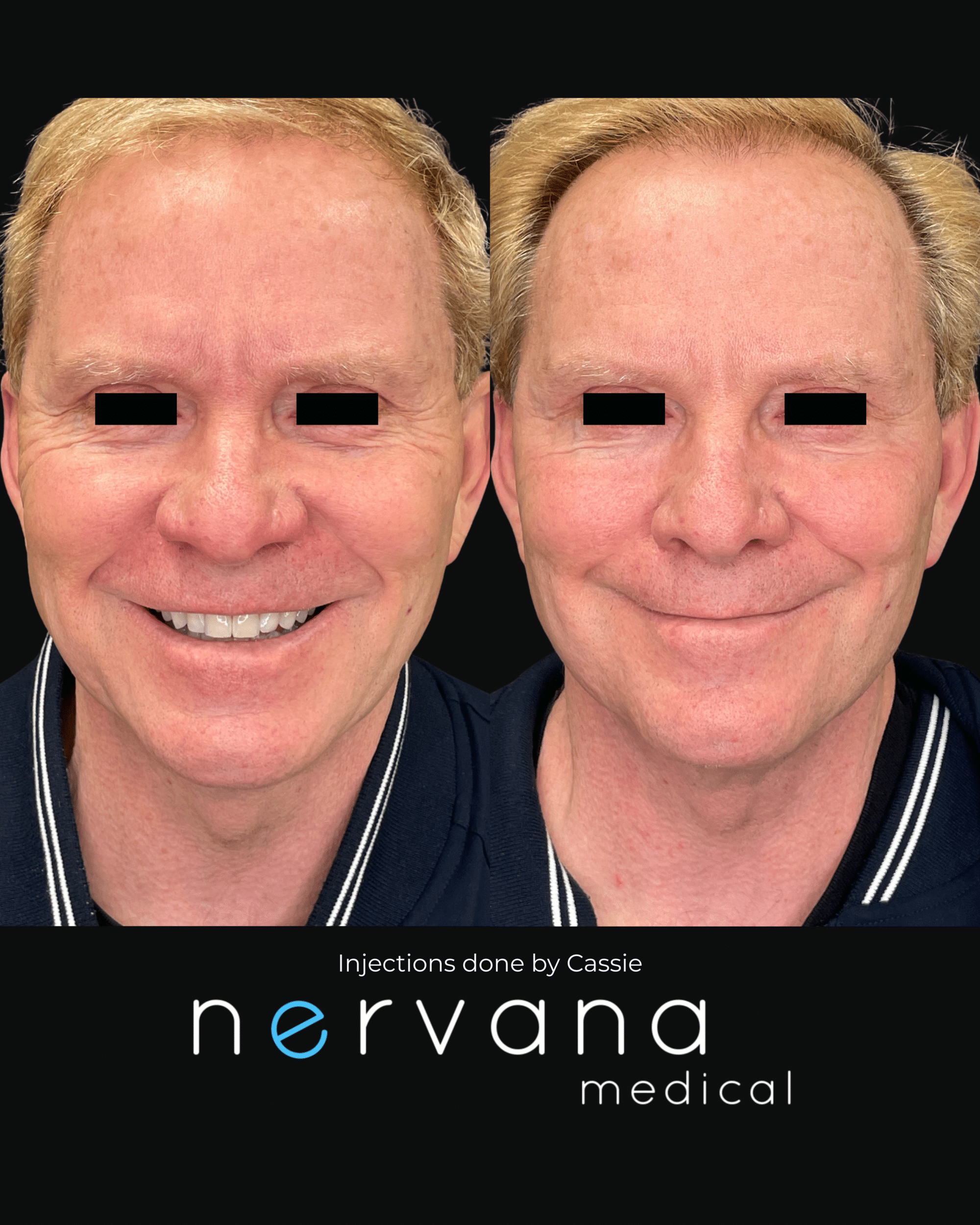 Before and After Image: Injections - front