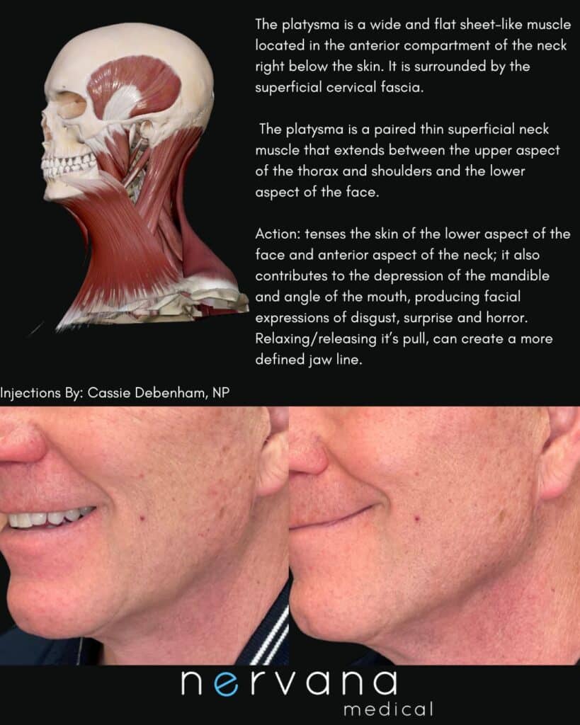Before and After Image: Injections - left-front-oblique