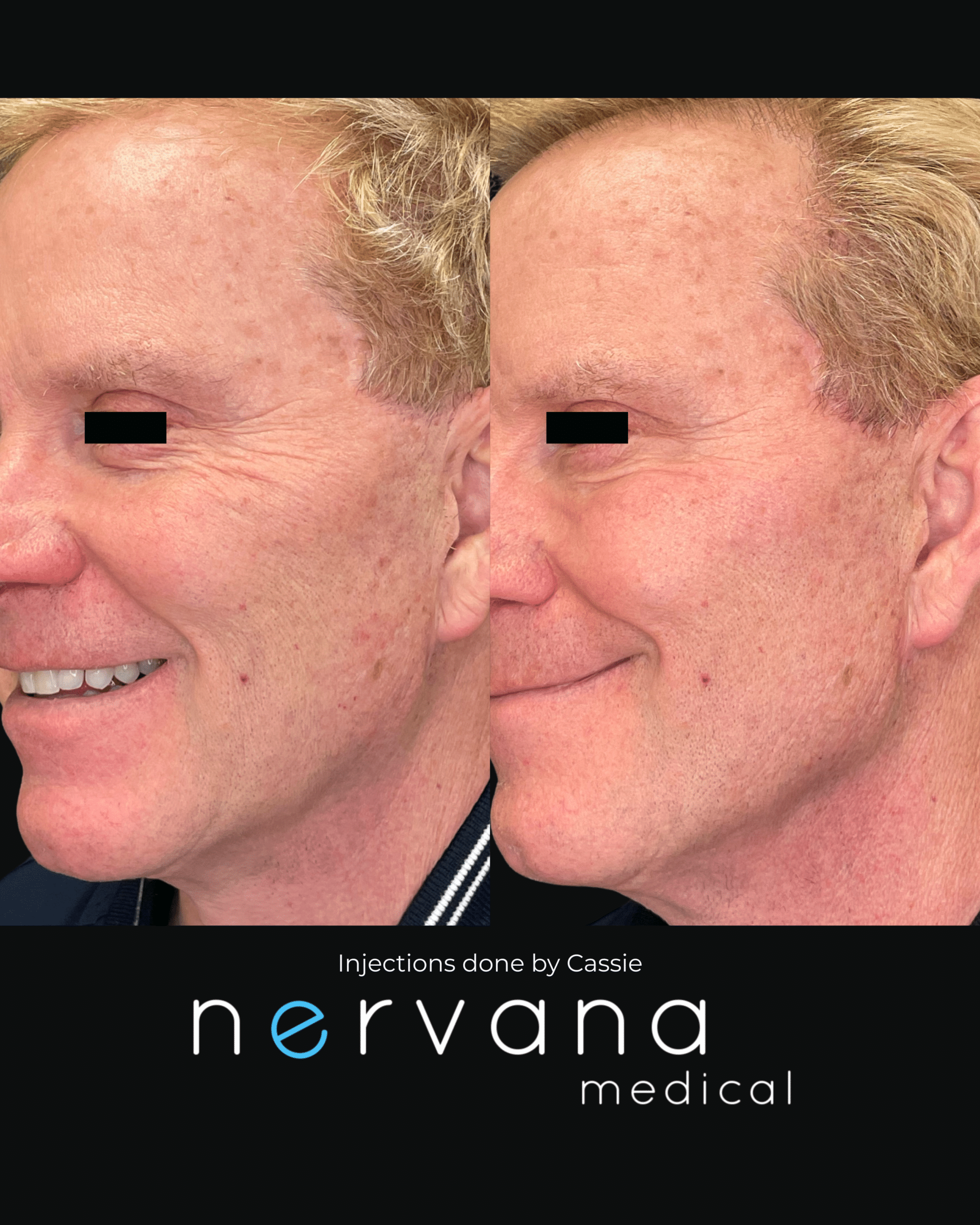 Before and After Image: Injections - left-front-oblique