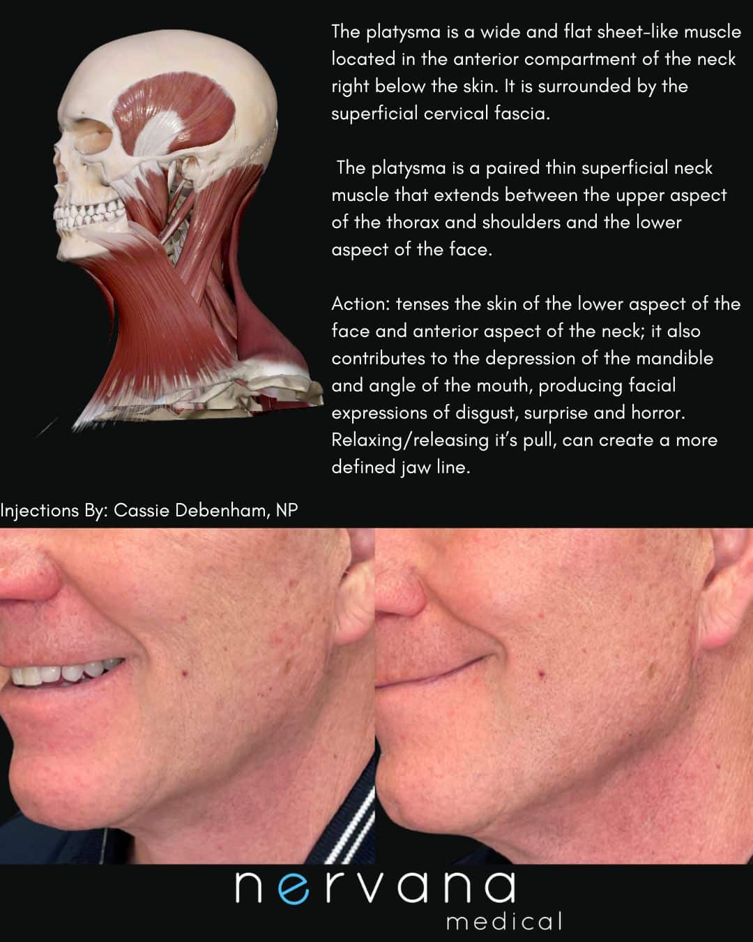 Before and After Image: Injections - left-front-oblique