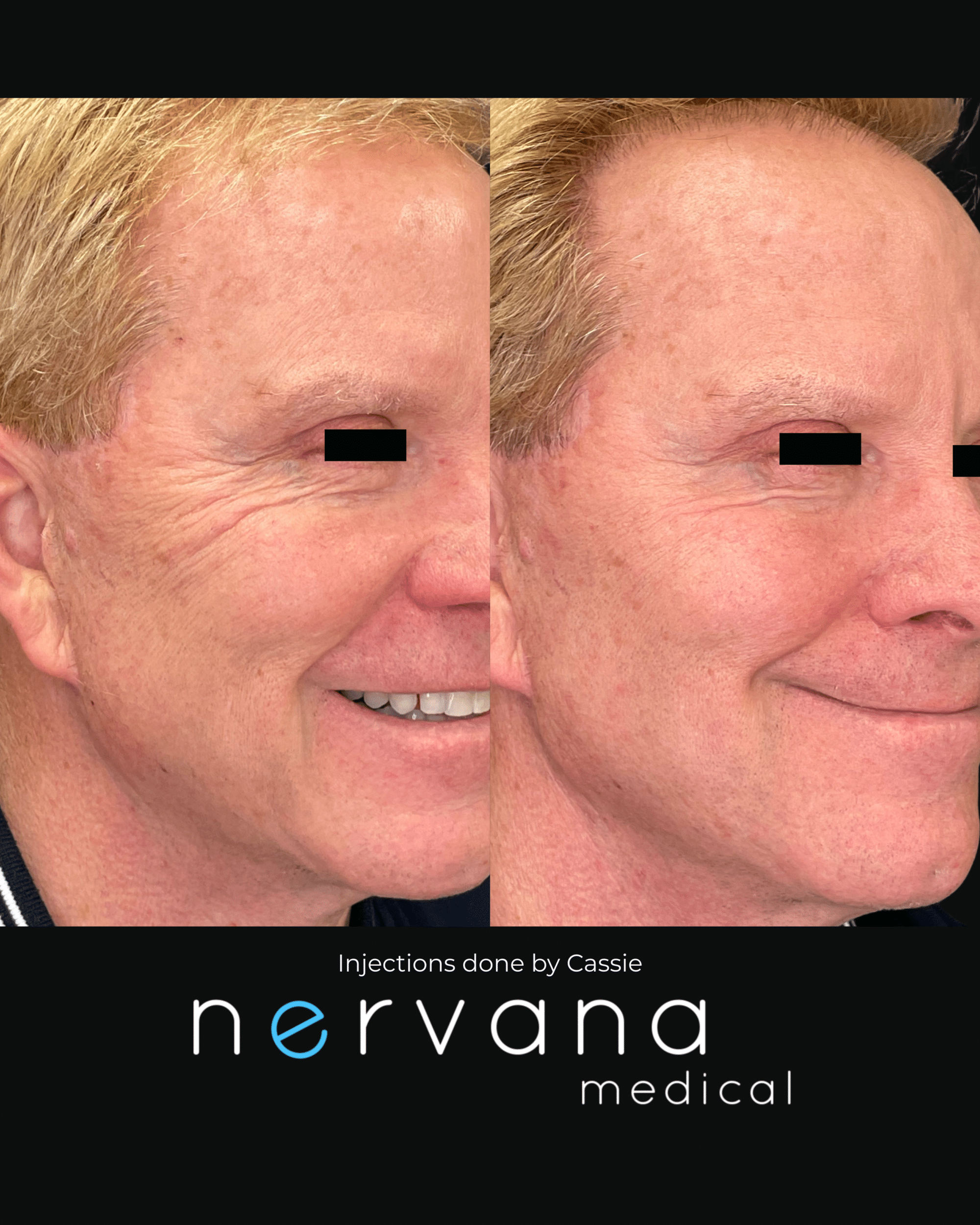 Before and After Image: Injections - right-front-oblique