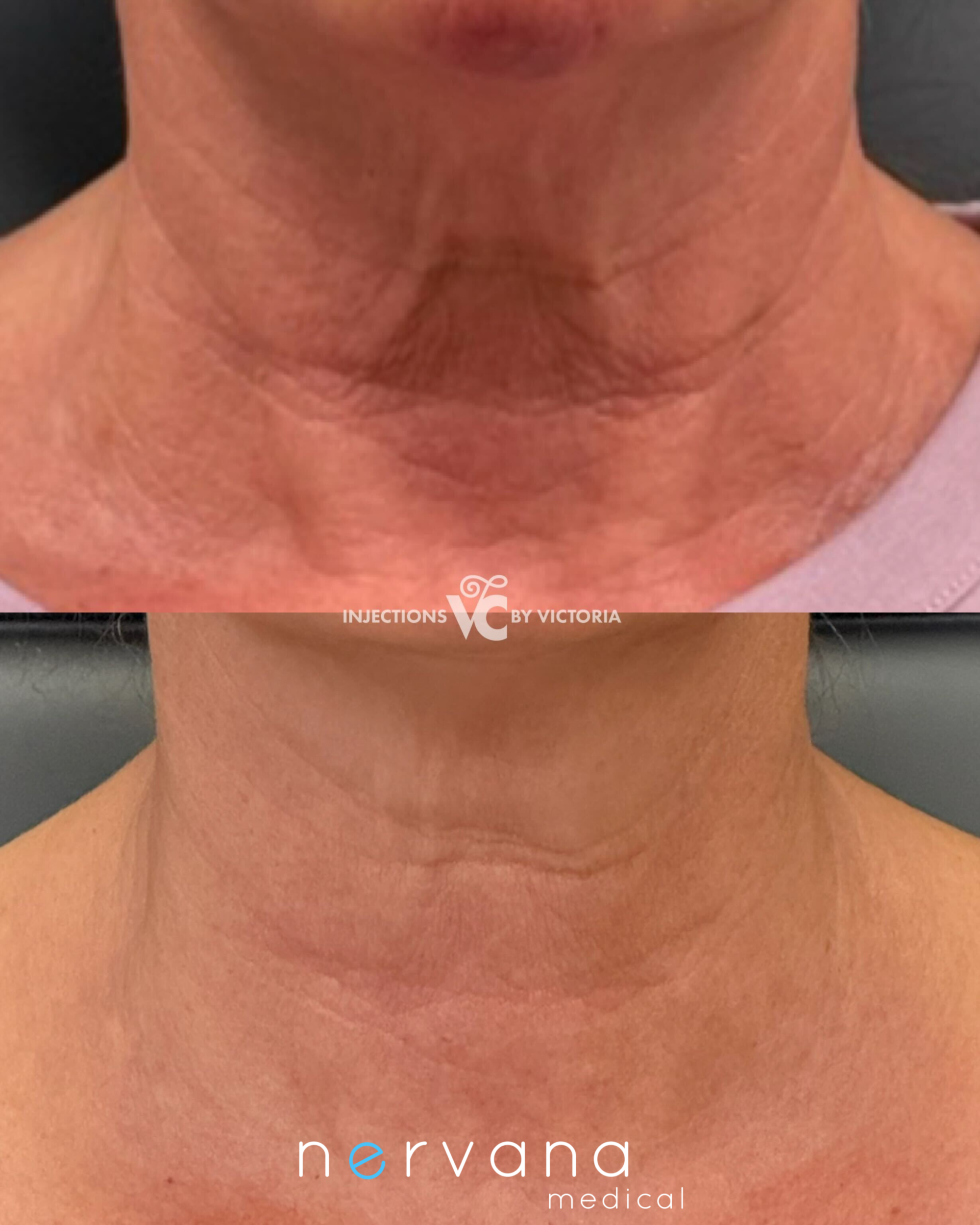 Before and After Image: Injections - front