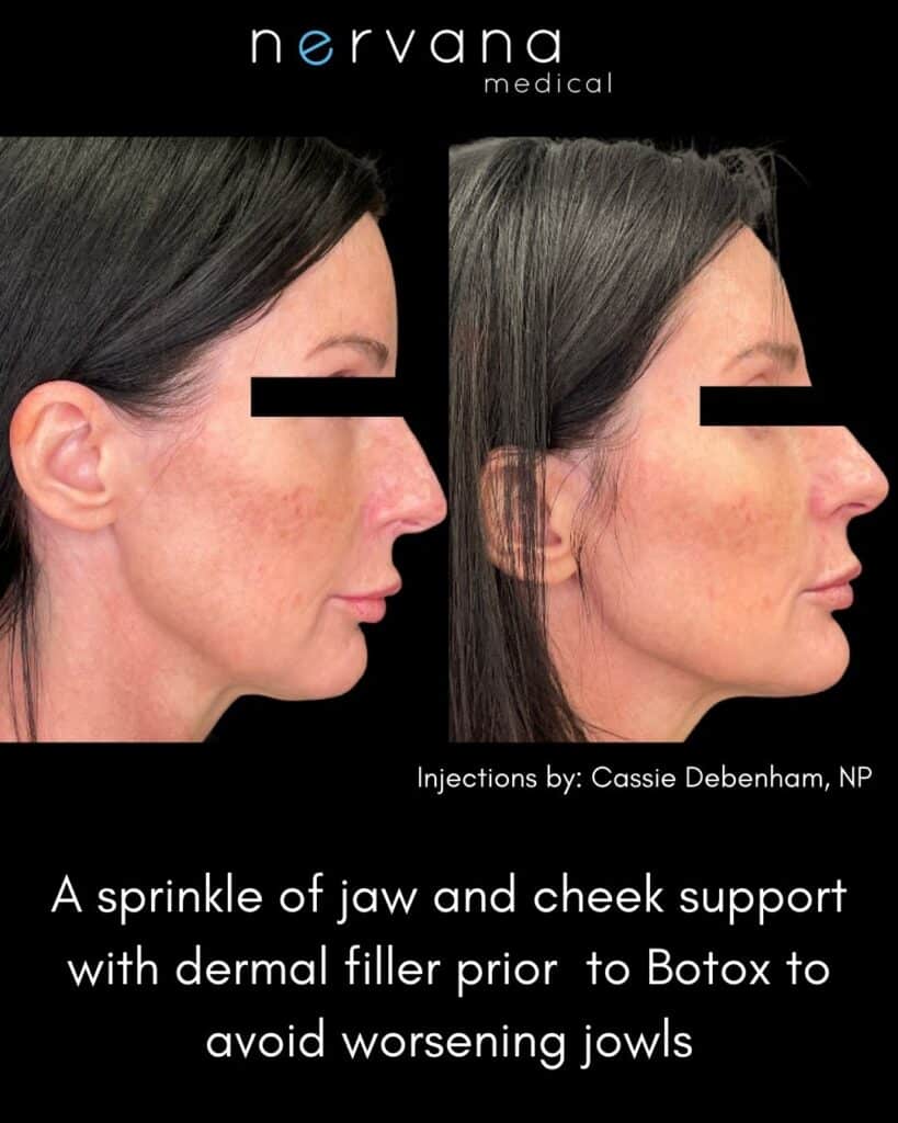 Before and after full facial balancing with dermal filler at Nervana Medical in Sandy, UT