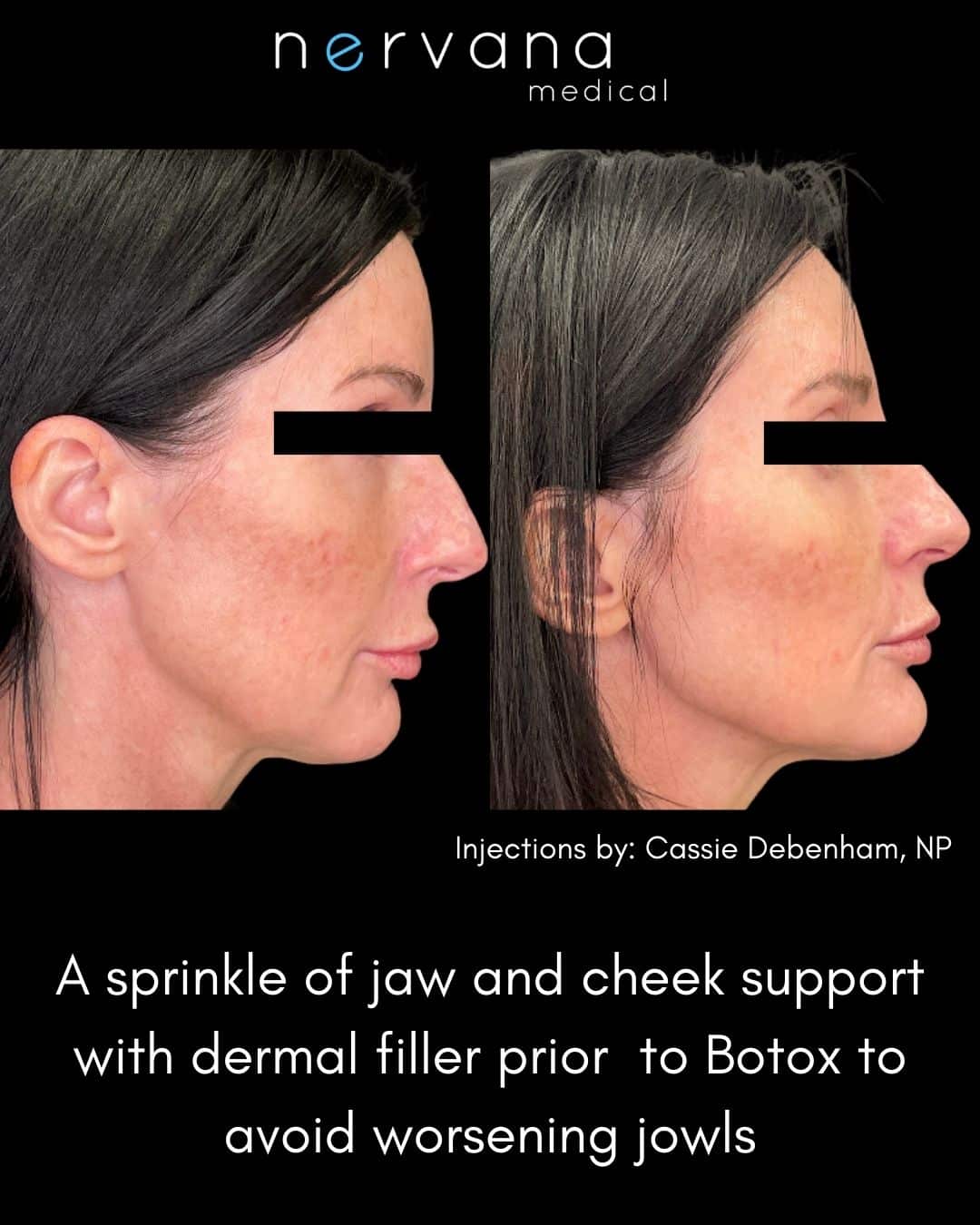 Before and After Image: Jaw and Cheek Support with Dermal Filler - right-side