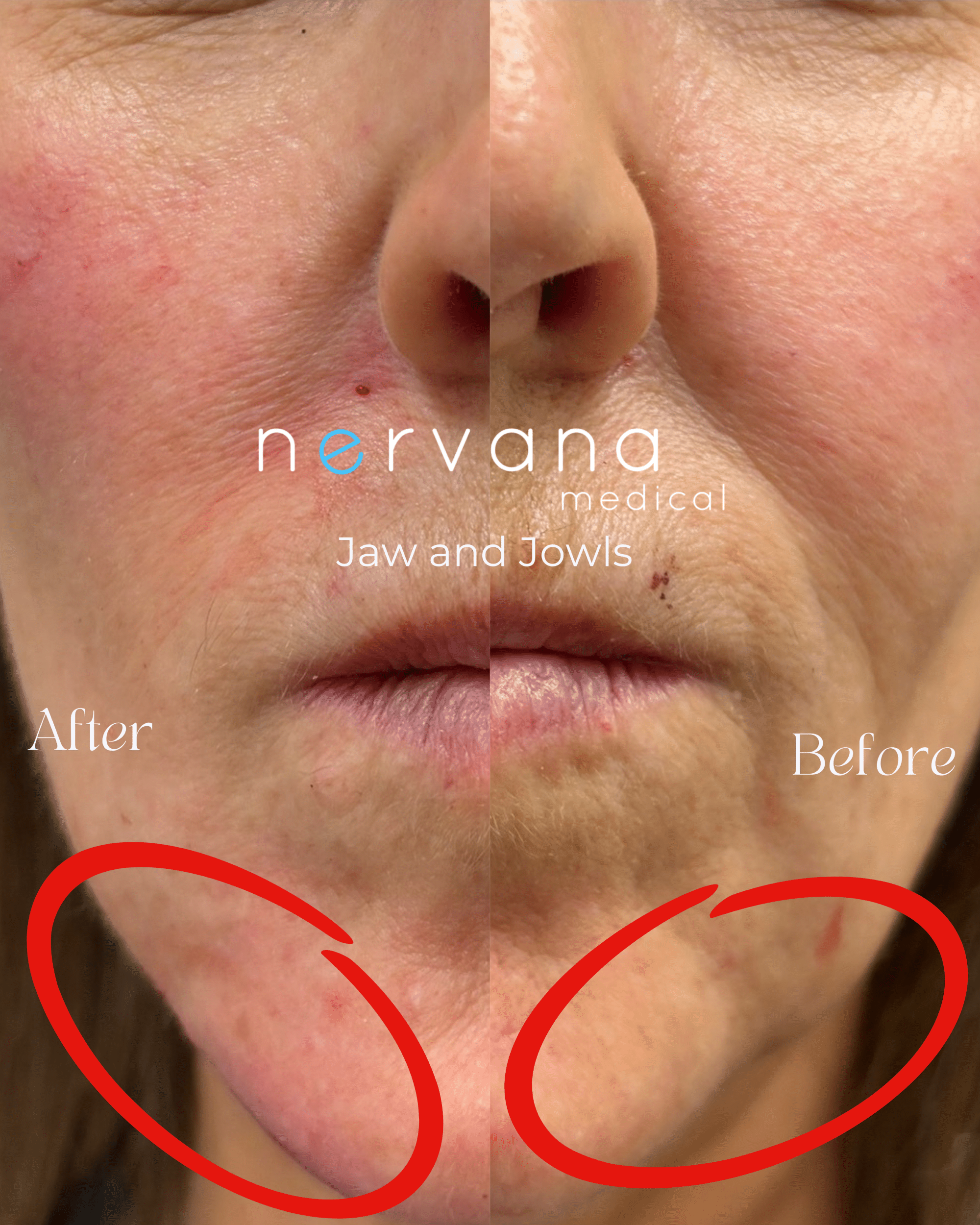 Before and After Image: Jaw and Jowls - front