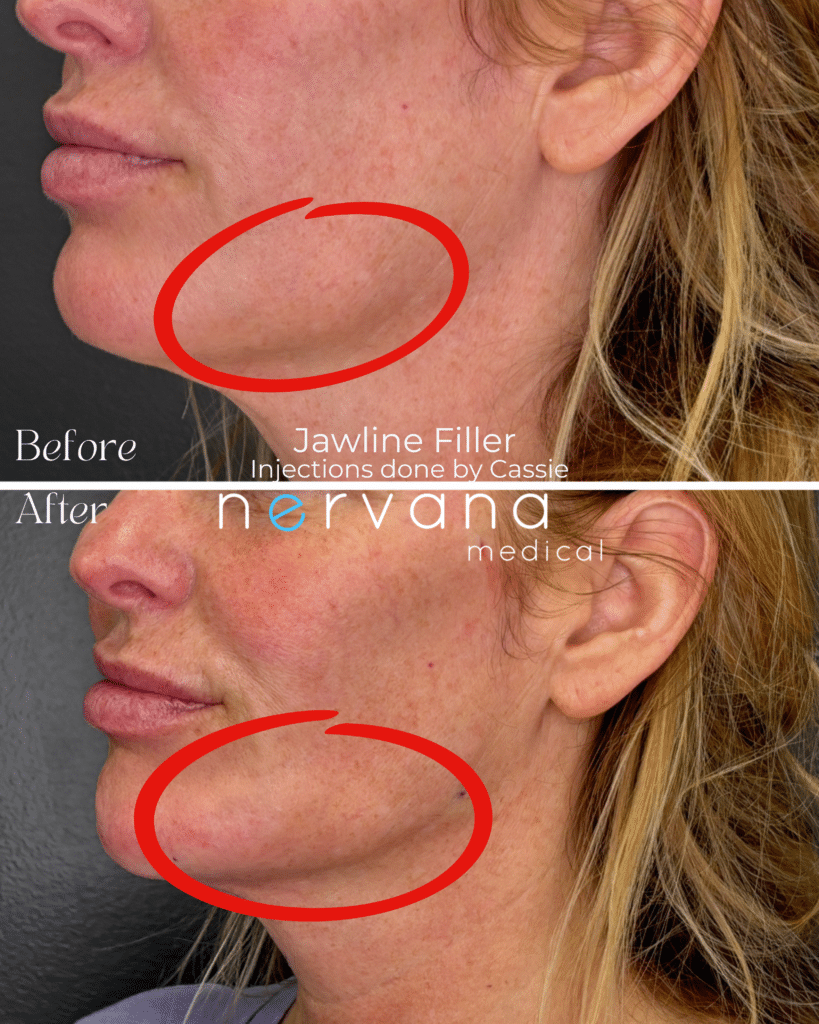 Before and After Image: Jawline - left-front-oblique
