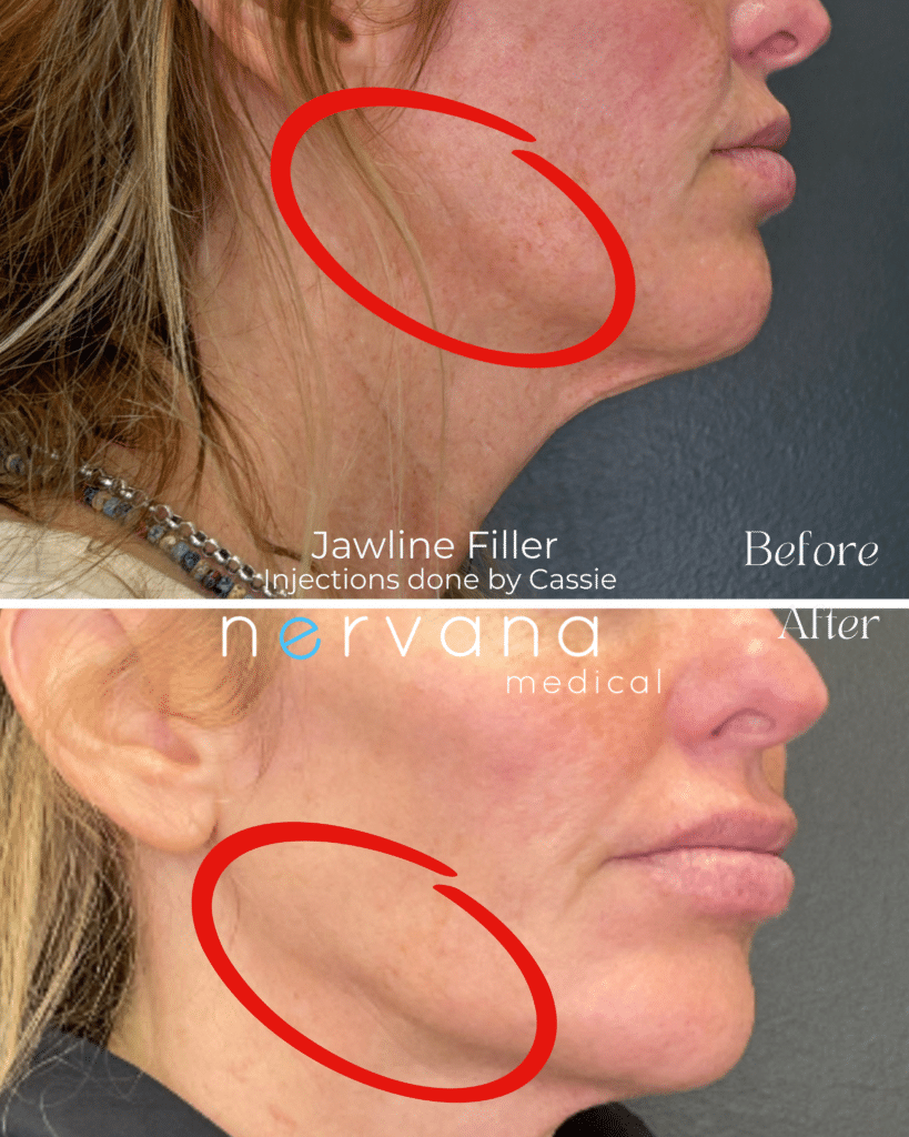 Before and After Image: Jawline - right-front-oblique