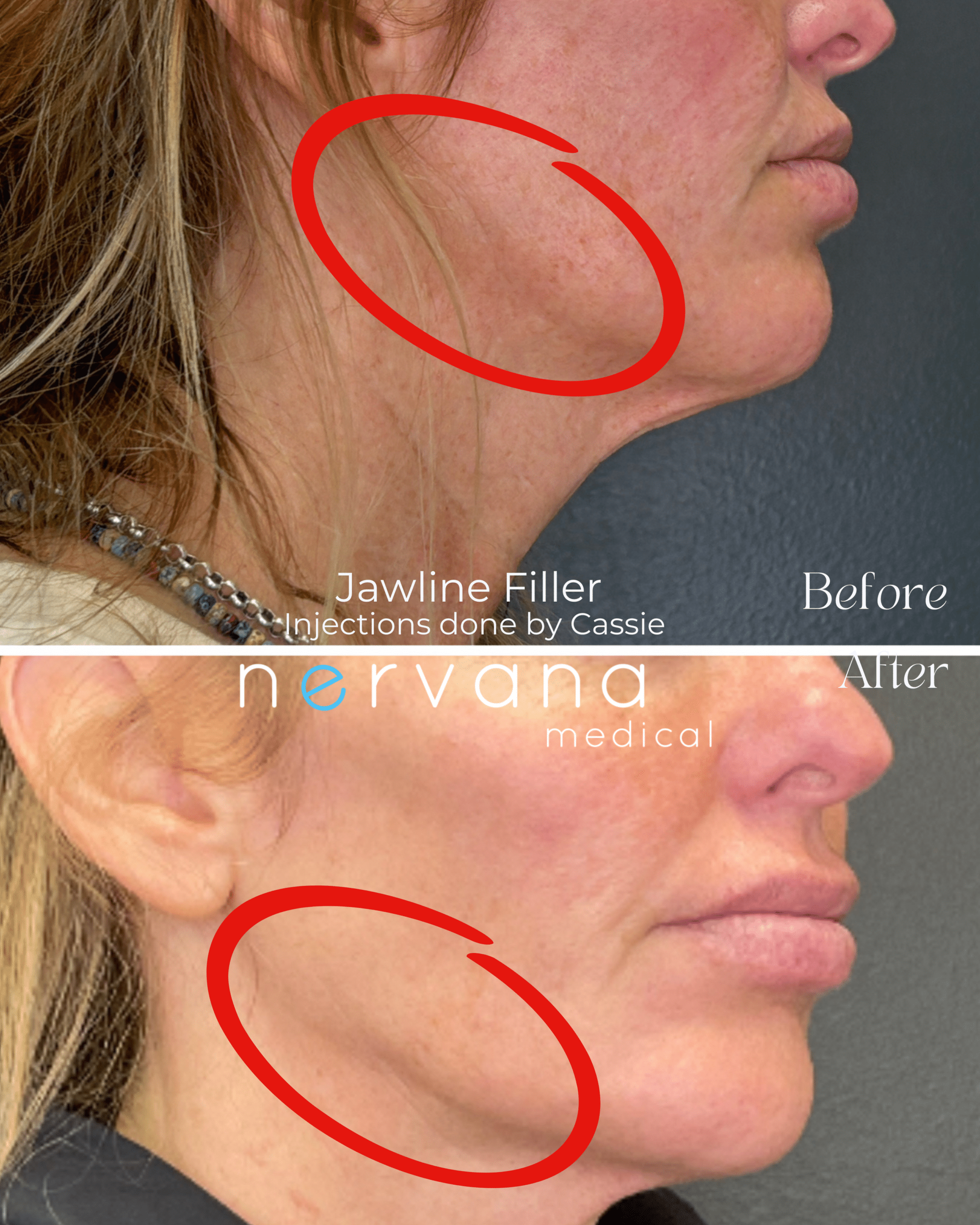 Before and After Image: Jawline - right-front-oblique