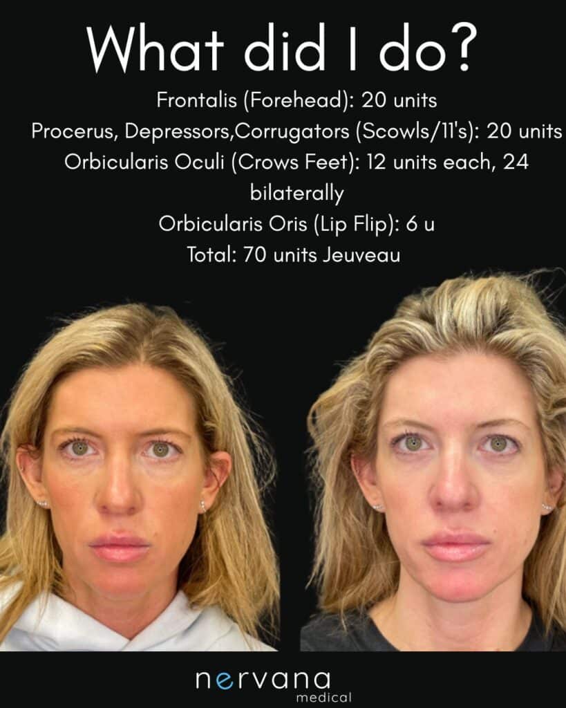 Before and After Image: Neuromodulators-Jeuveau - front