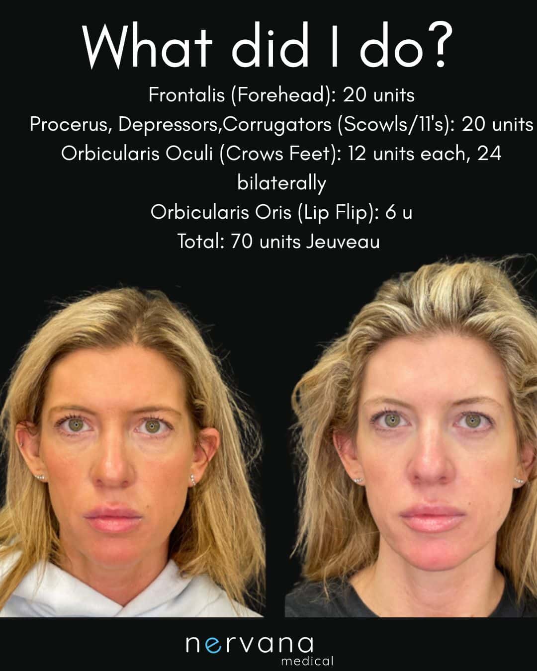 Before and After Image: Jeuveau - front