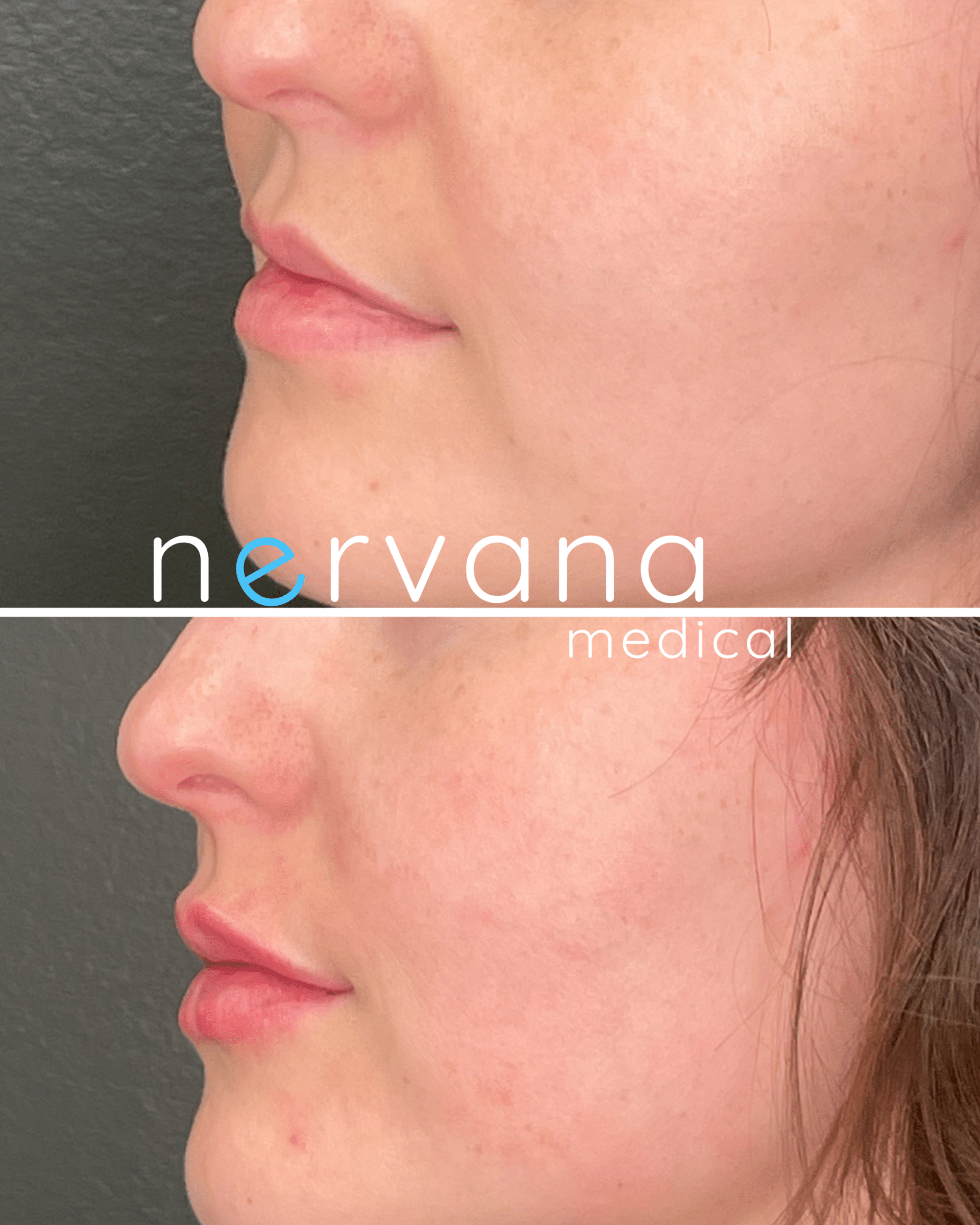 Before and After Image: Juvederm XC Lips - left-front-oblique