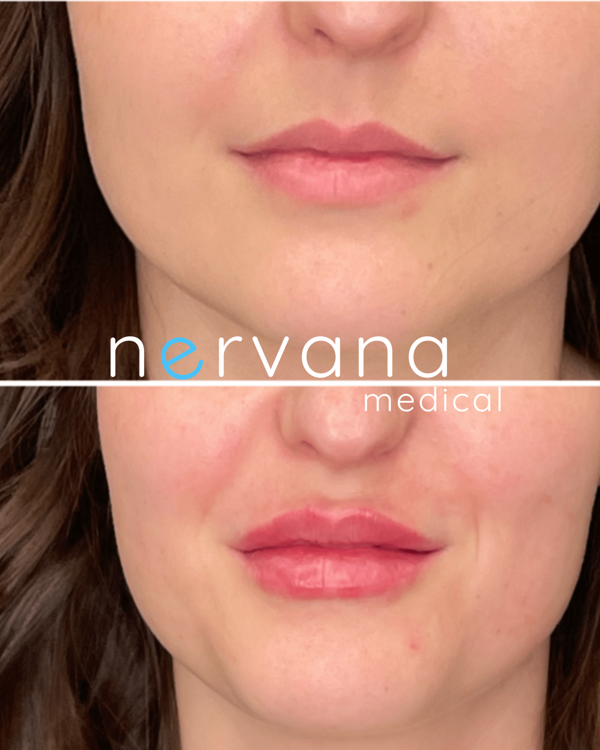 Before and After Image: Juvederm XC Lips - front
