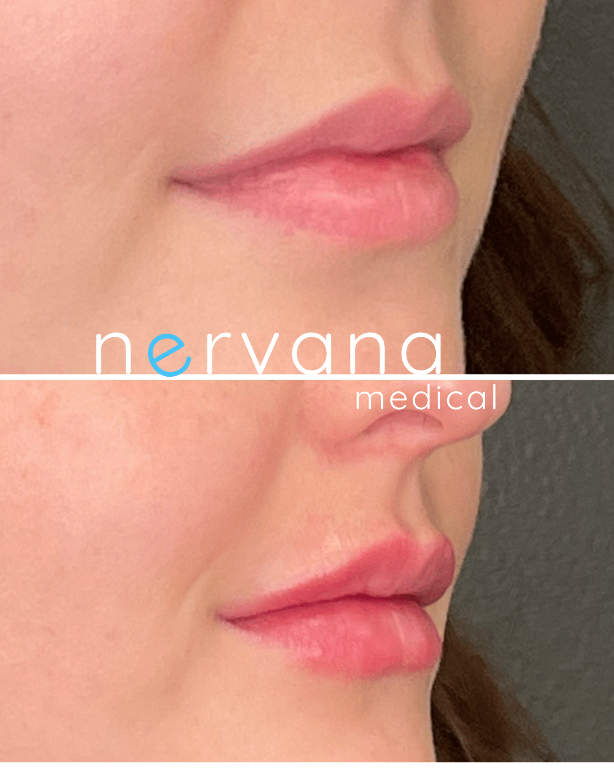 Before and After Image: Juvederm XC Lips - right-front-oblique
