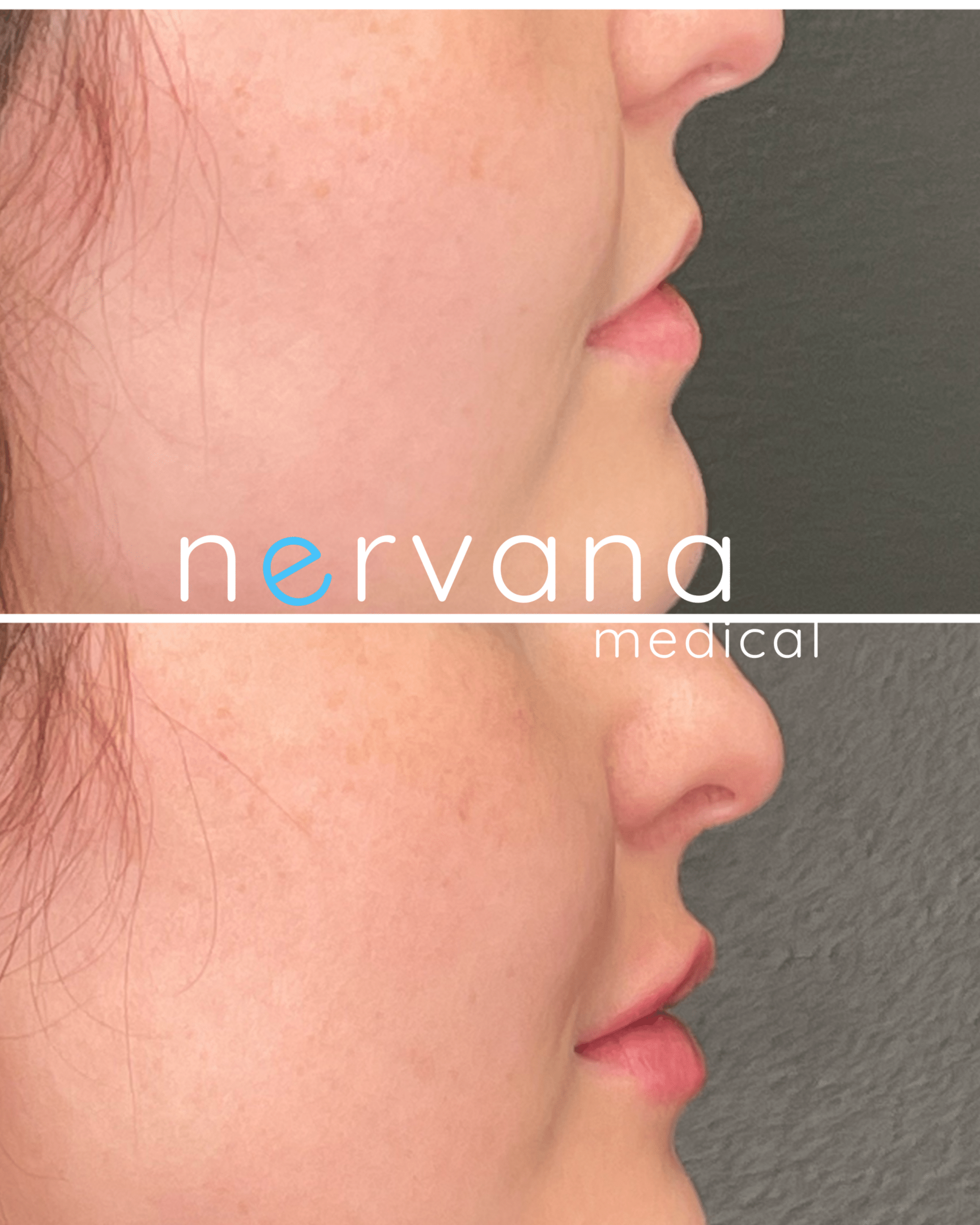 Before and After Image: Juvederm XC Lips - right-side