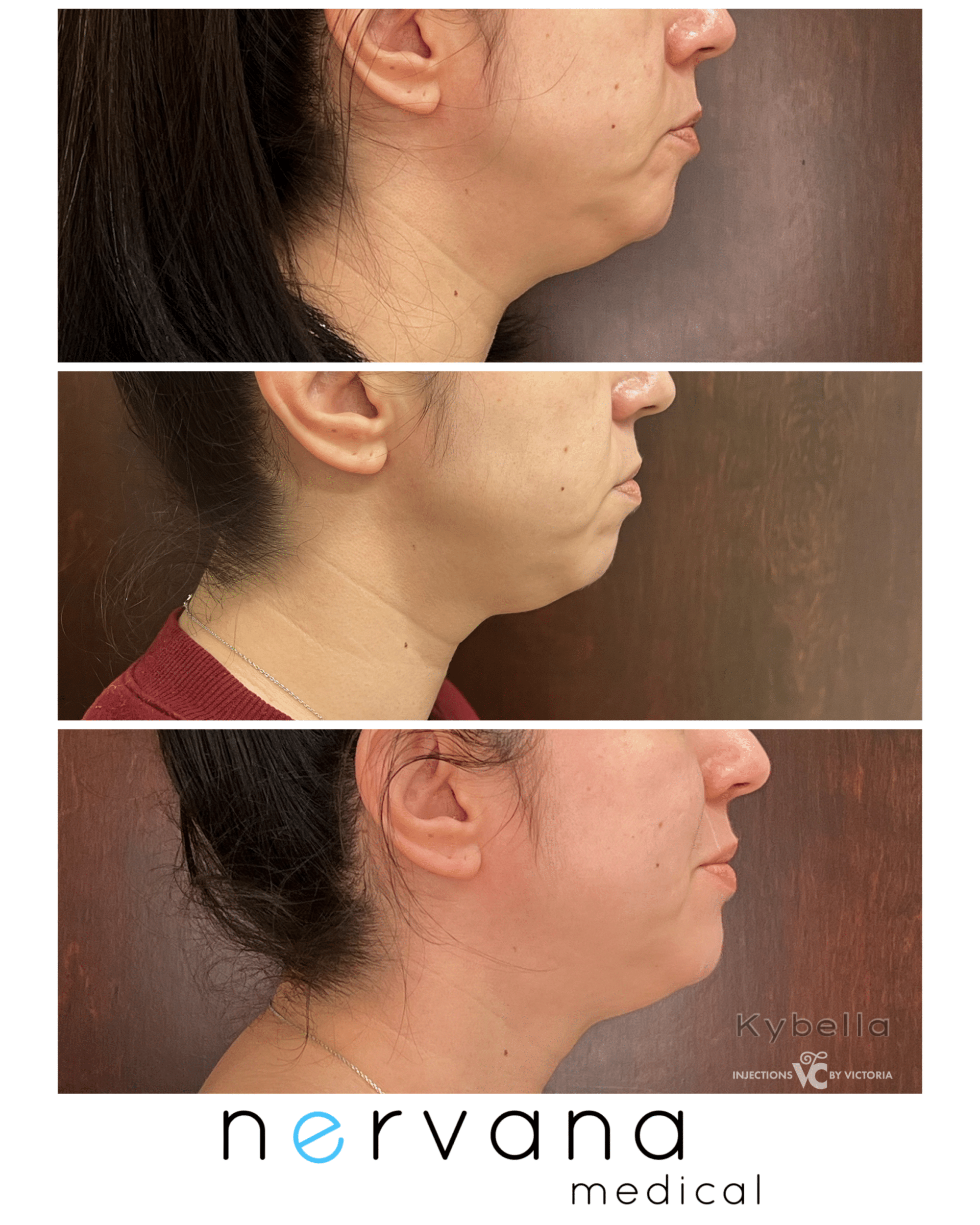 Before and After Image: Kybella - right-side