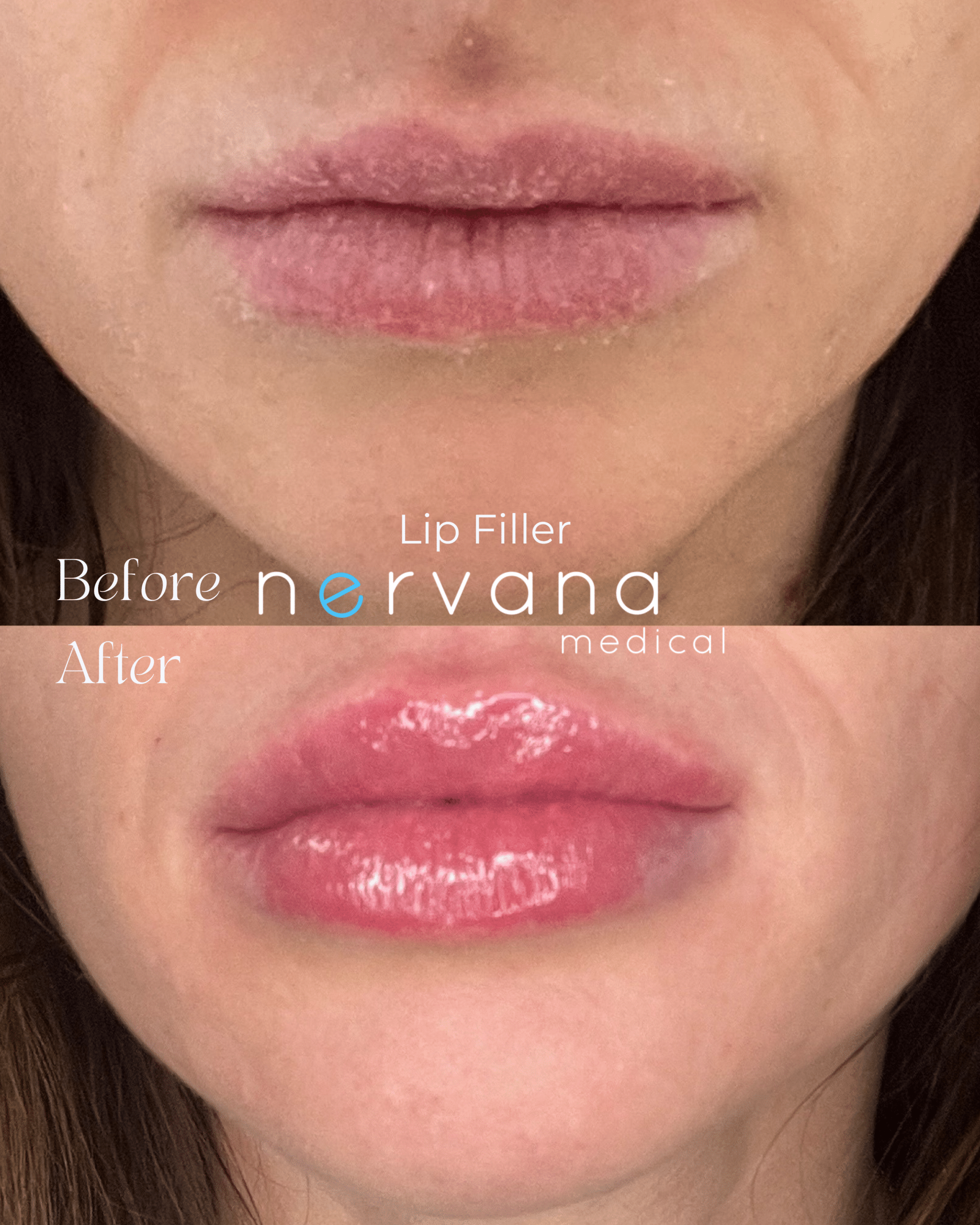 Before and After Image: Lip Filler - front