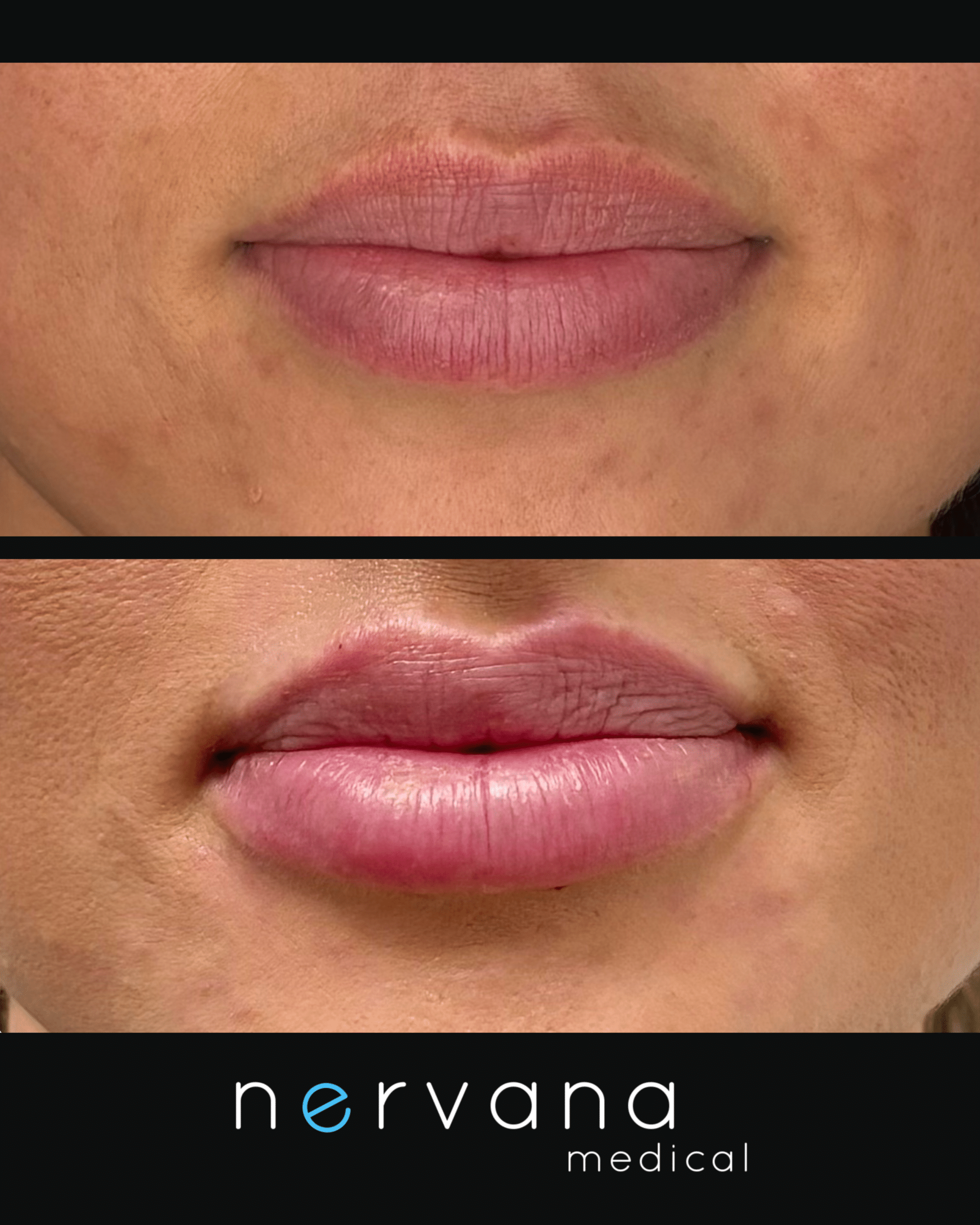 Before and After Image: Lip Filler - front