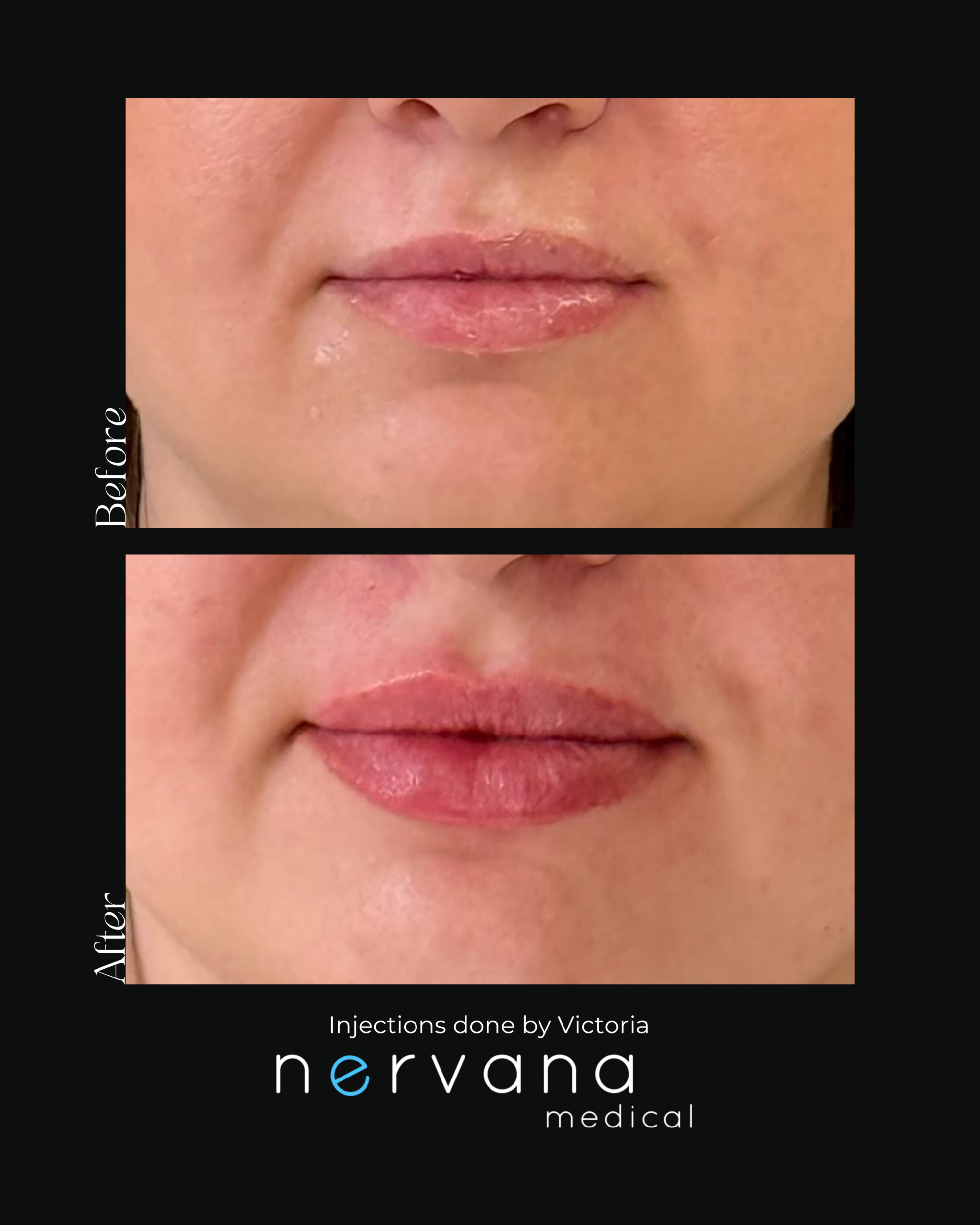 Before and After Image: Lip Injections - front