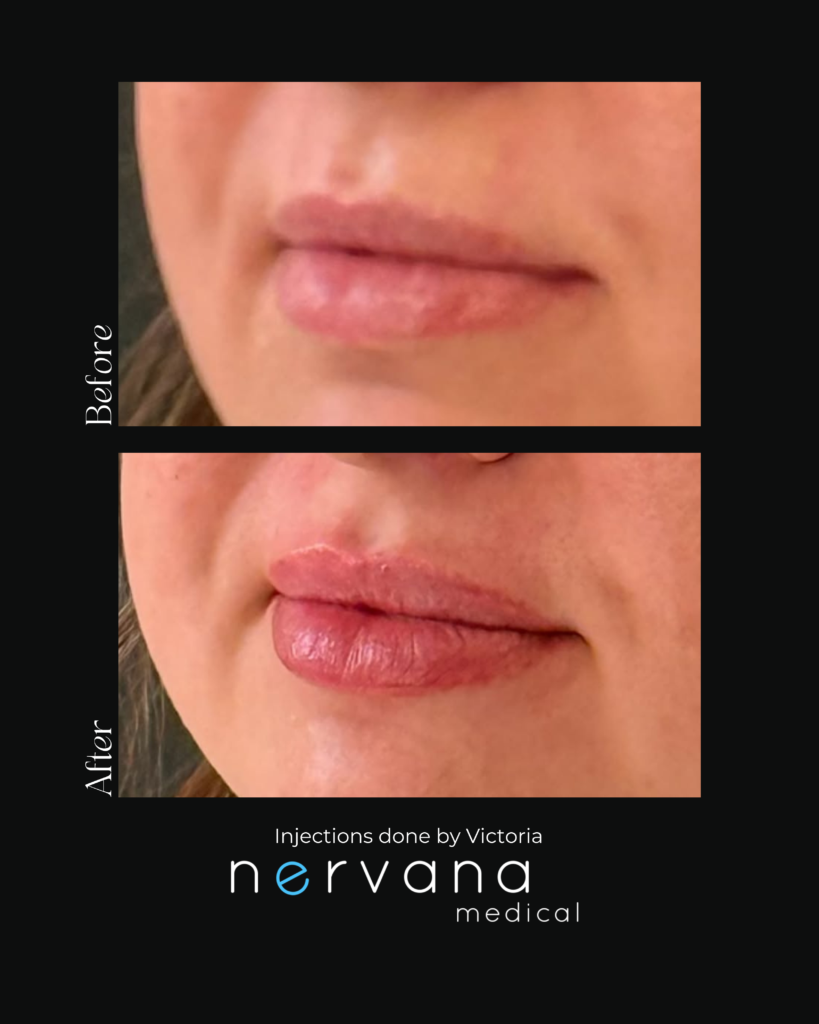 Before and After Image: Lip Injections - left-front-oblique