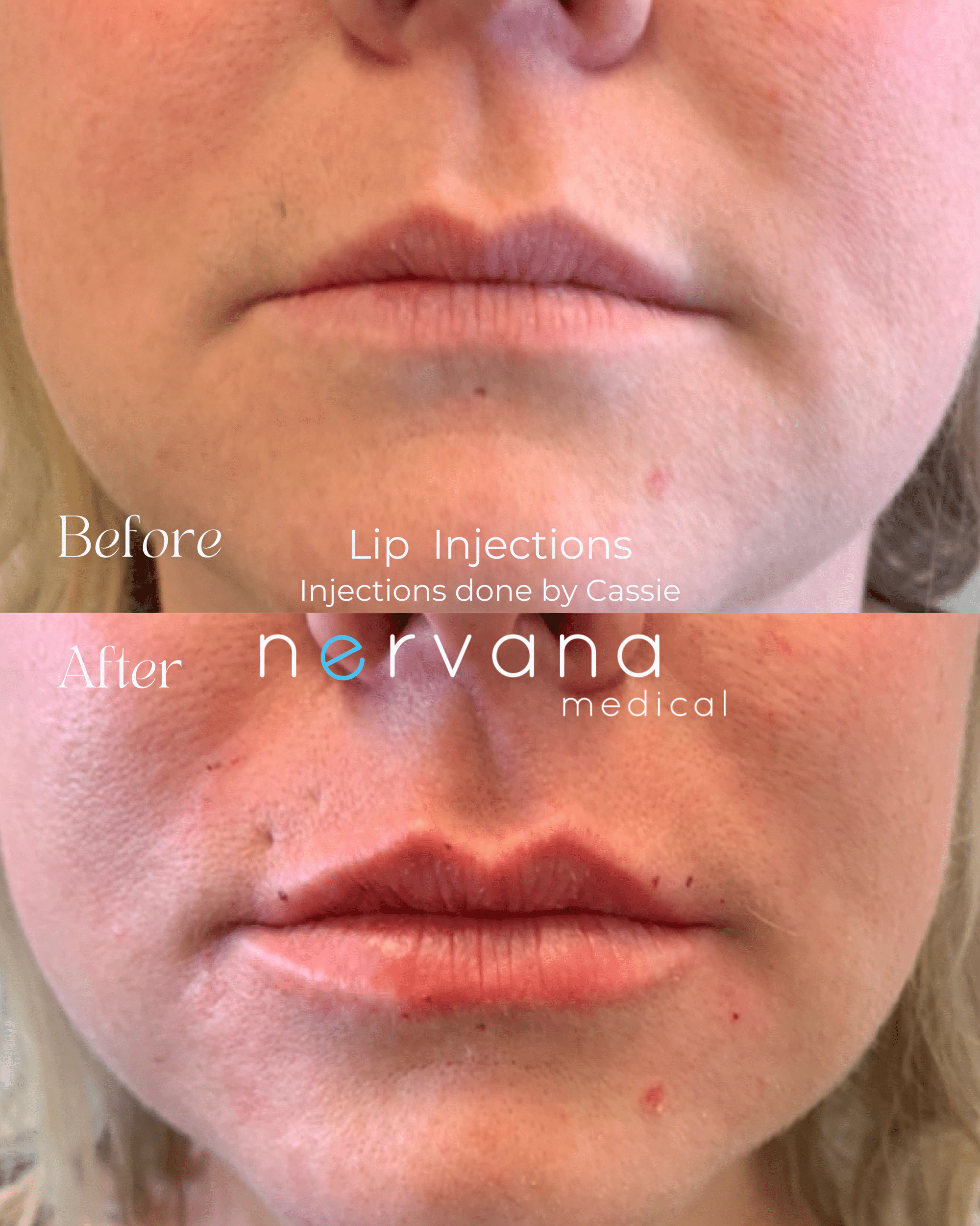 Before and After Image: Lip Injections - front