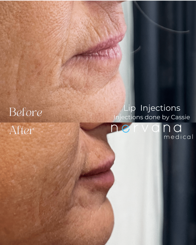 Before and After Image: Vertical Lip Lines/”Smoker-Straw Lines” - right-side