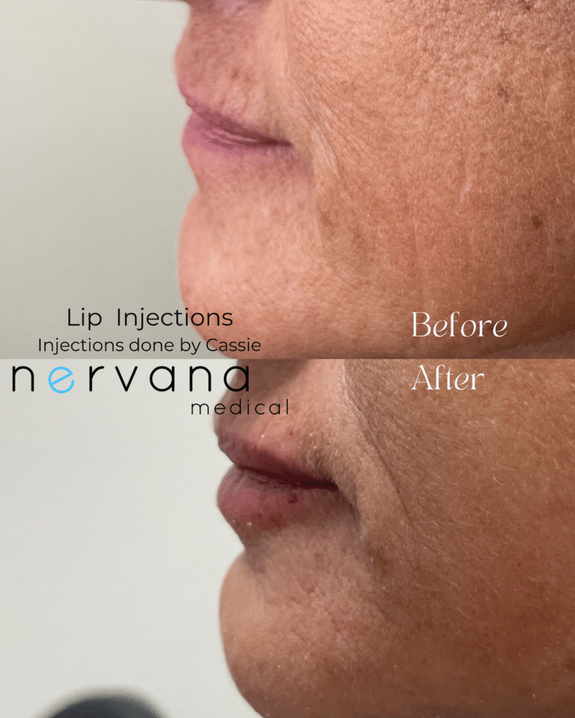 Before and After Image: Vertical Lip Lines/”Smoker-Straw Lines” - left-side