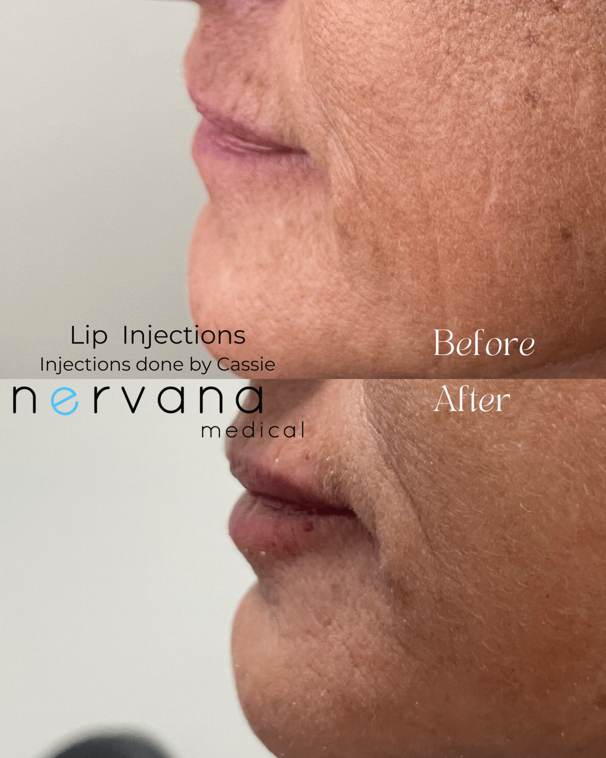 Before and After Image: Lip Injections - left-side