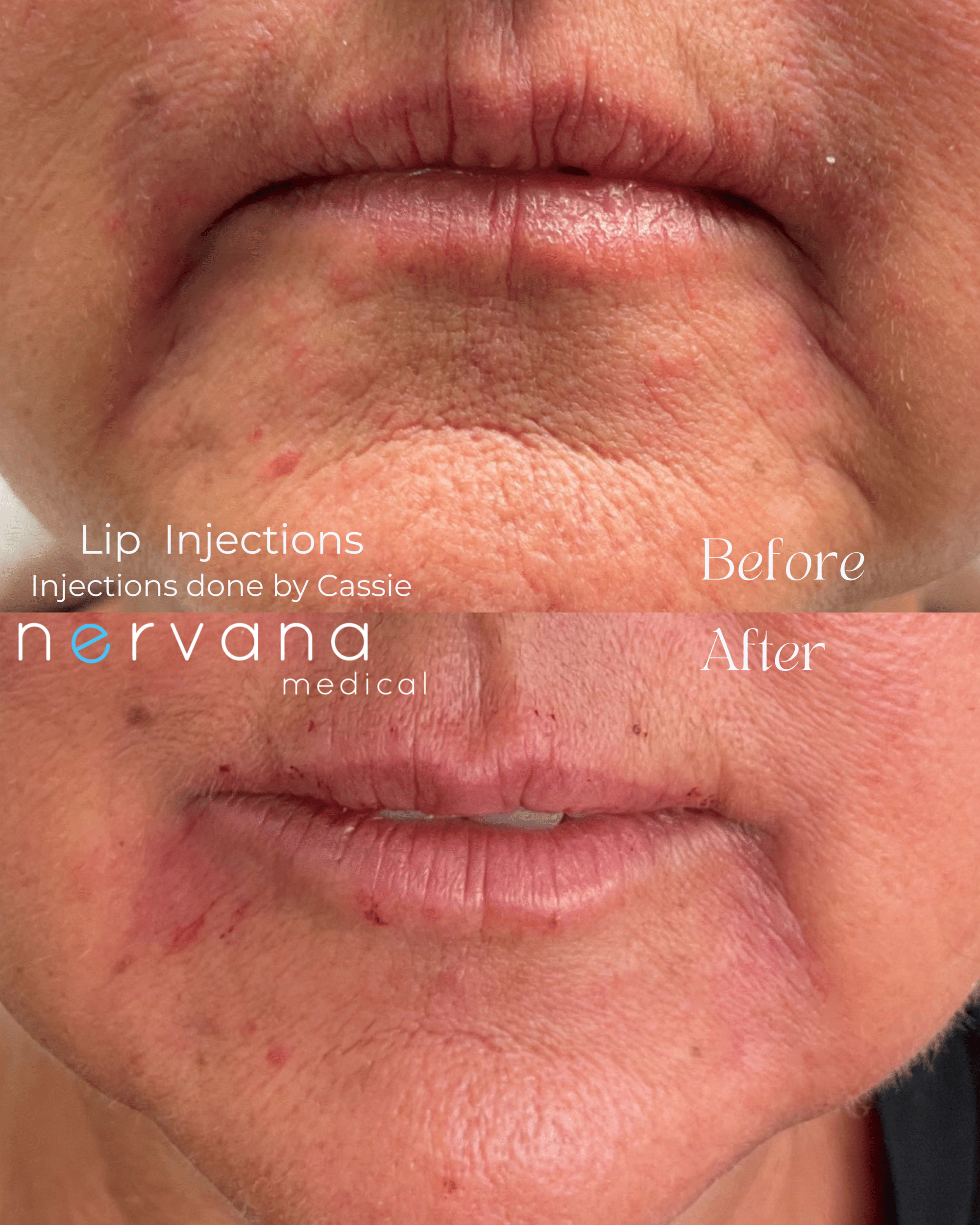 Before and After Image: Lip Injections - front